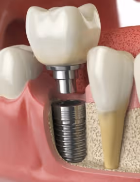Detailed cross-section illustration of a dental implant showing the implant screw embedded in the jawbone with an abutment and crown attached above the gumline.