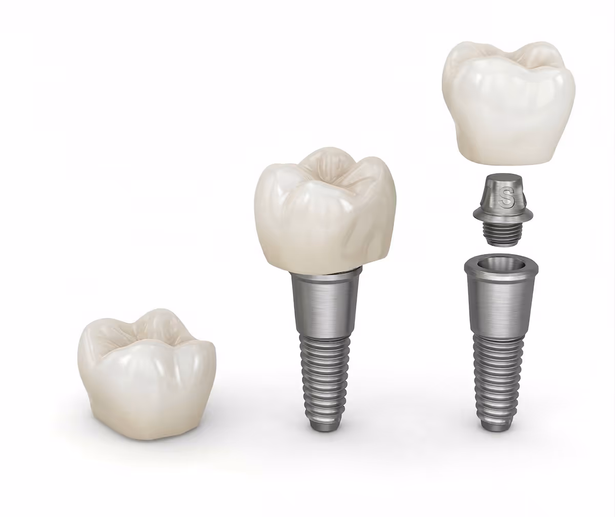 Three dental crowns with one fully assembled on a metal implant screw and another partially disassembled showing its components.