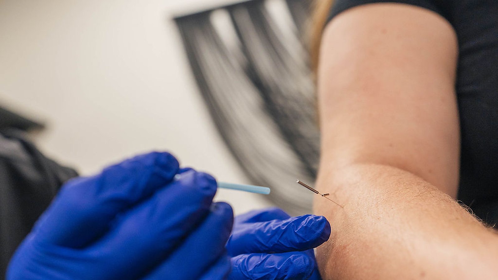 Kee Health provider in blue gloves placing a thin dry needle near a patient's elbow at our Waunakee clinic
