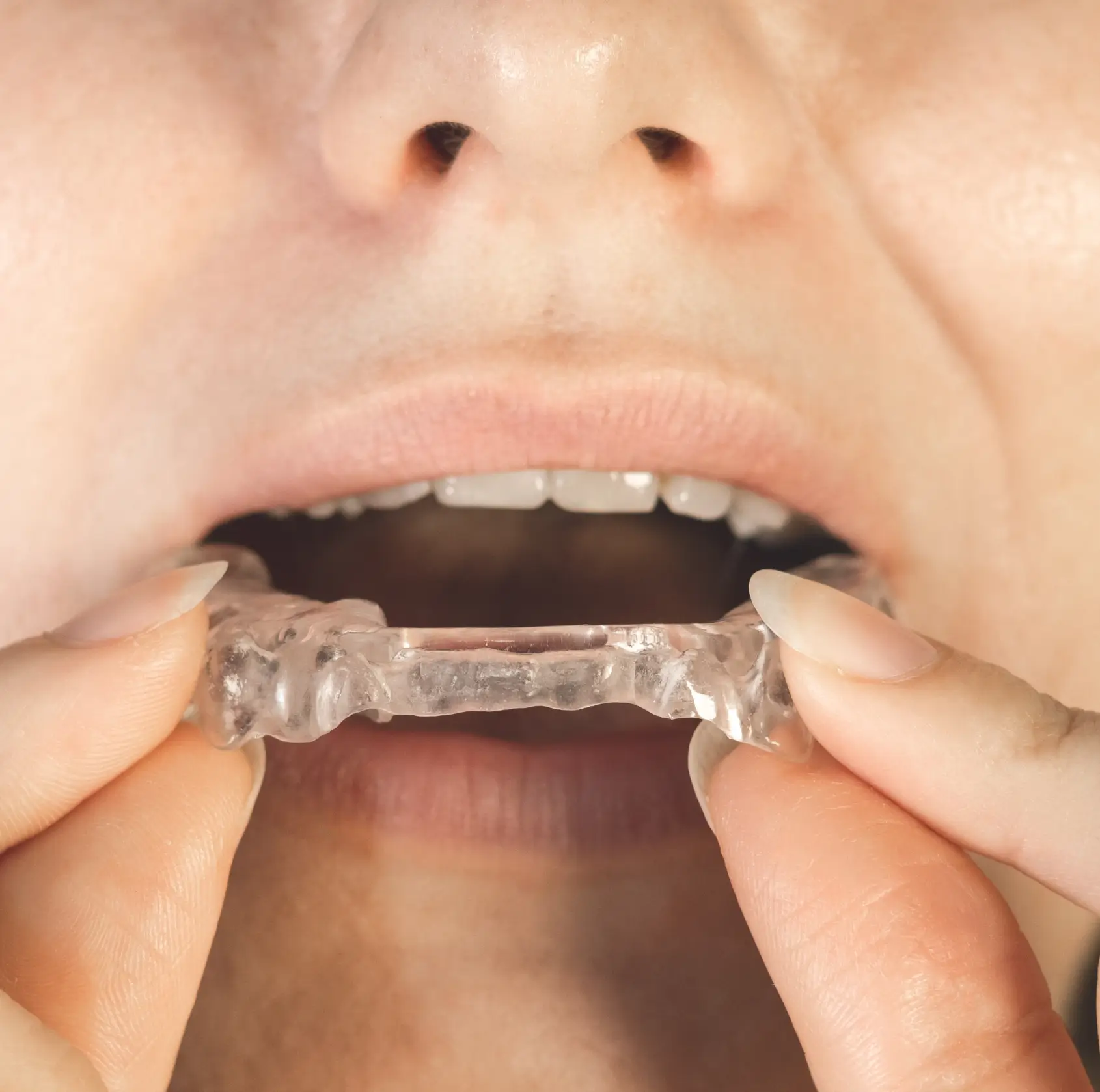 Person holding a clear dental night guard near their open mouth for teeth protection. La Perle Dental Center in Edmonton, AB TST 3T9