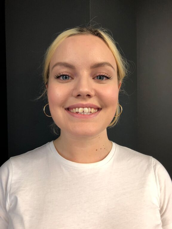 Zaleta leczenia nakładkowego Invisalign
