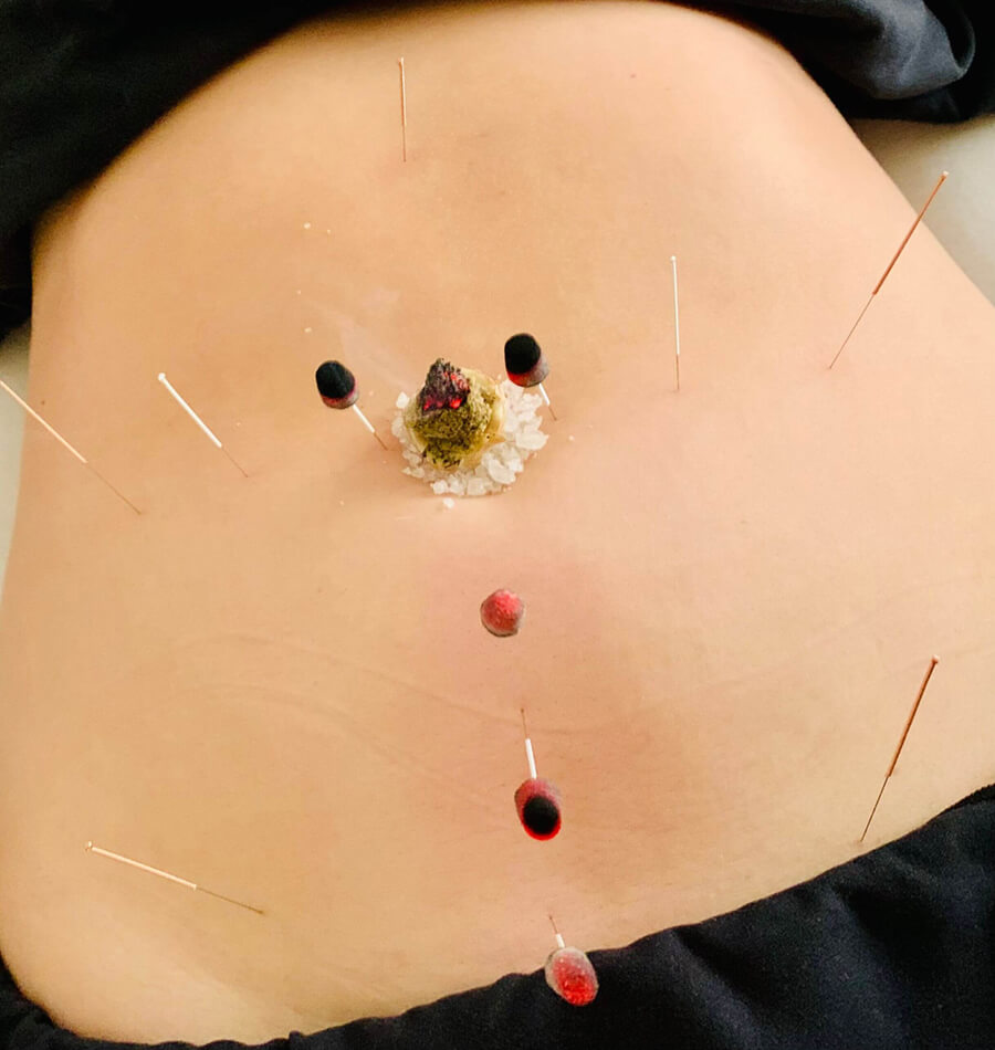 Moxibustion