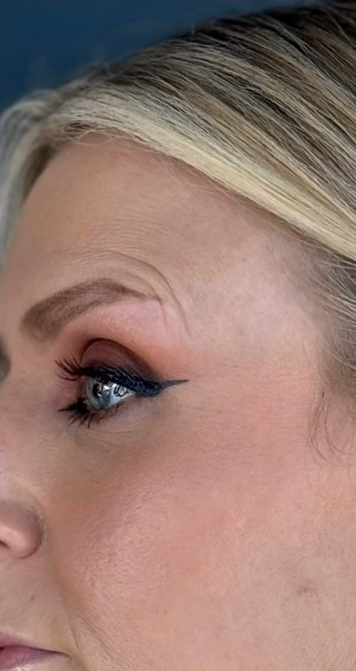 Microneedling treatment before.