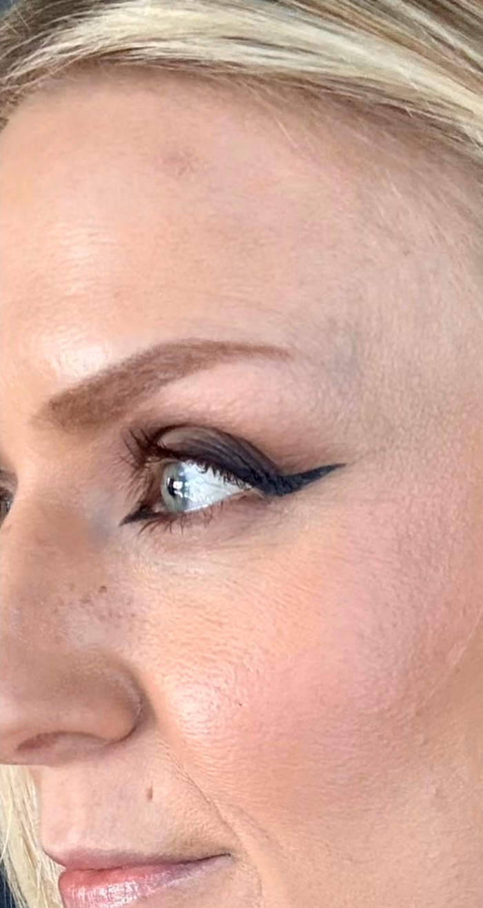 Microneedling treatment result after.