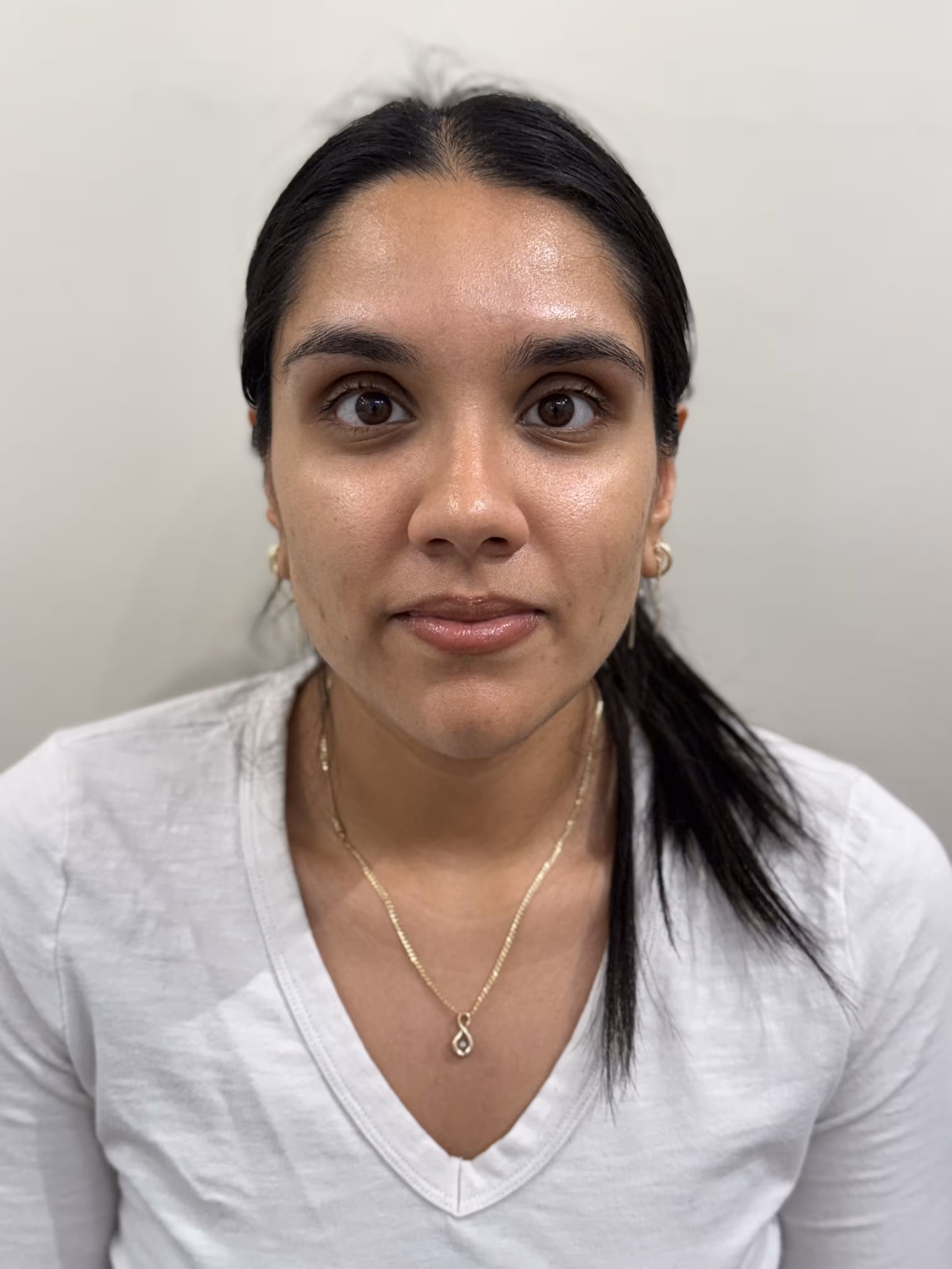 Dermal filler treatment result after.