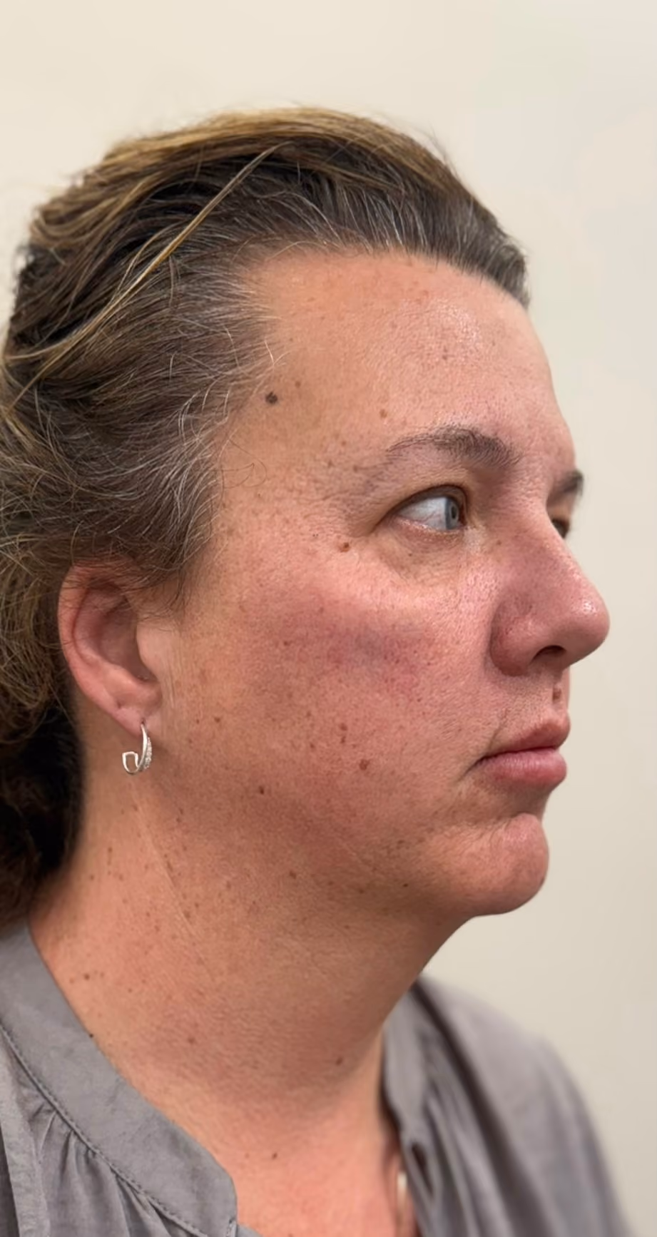 Dermal filler treatment result after.