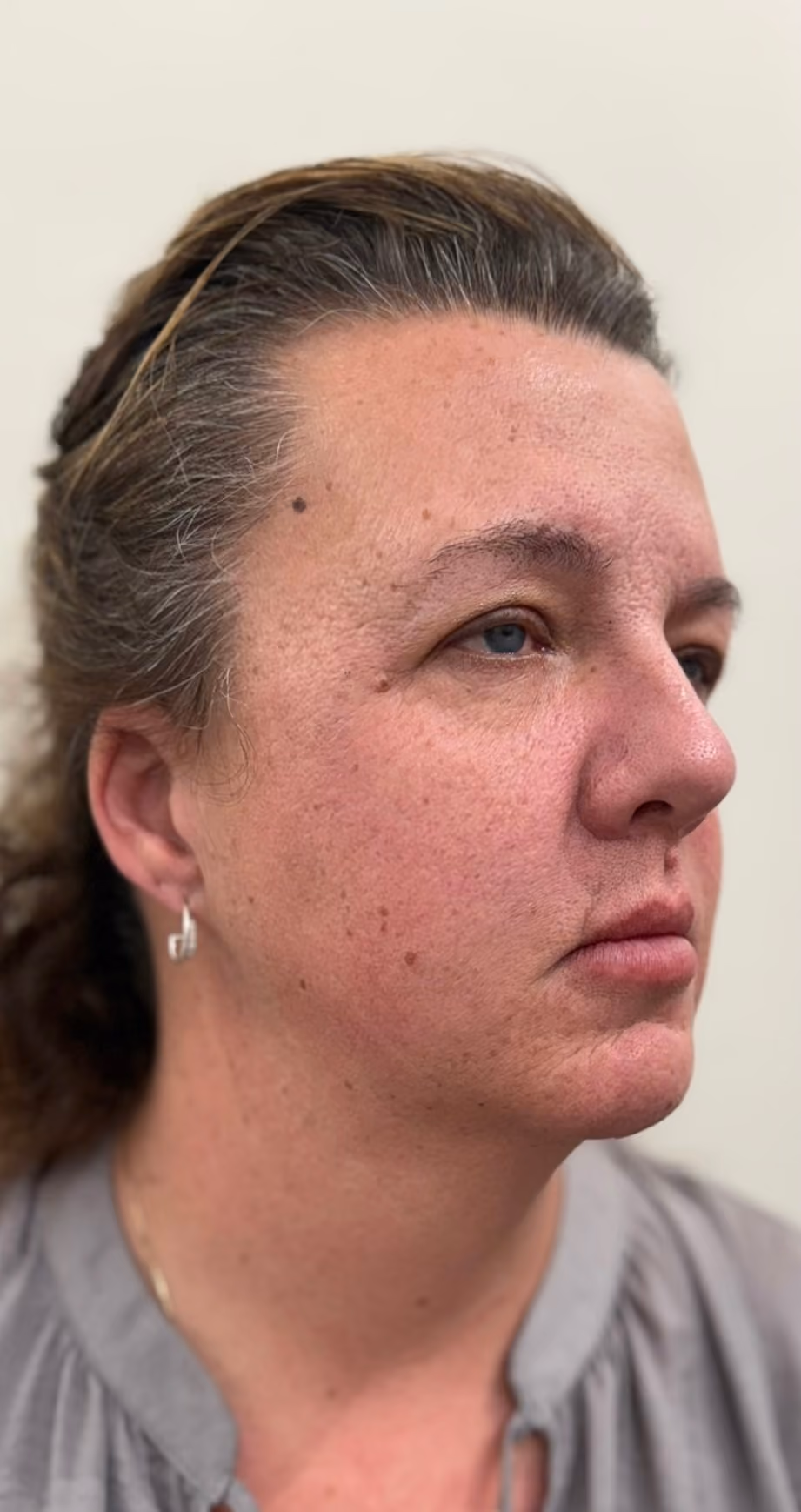 Dermal filler treatment before.