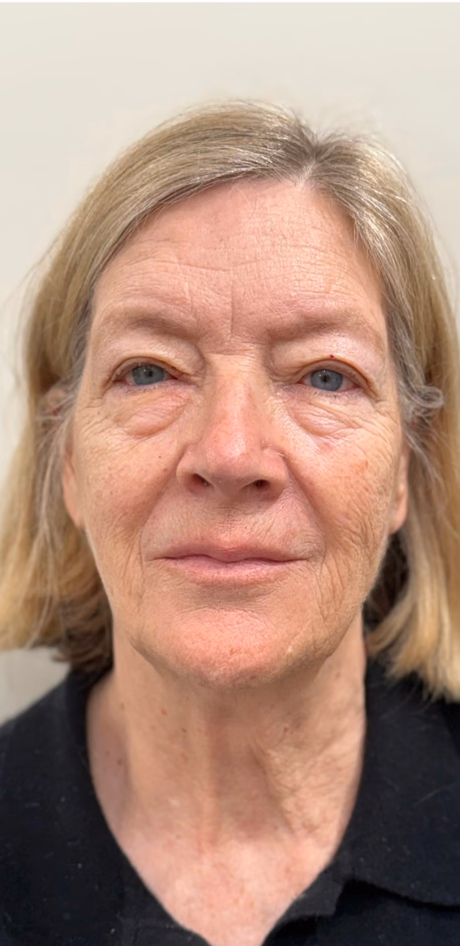 Microneedling treatment before.