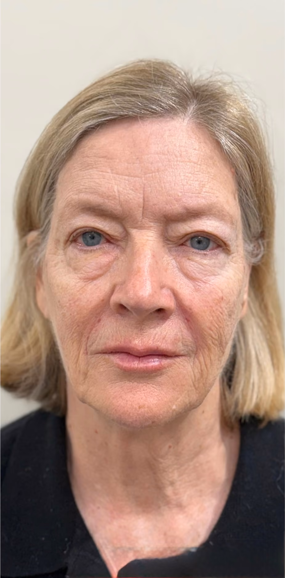 Microneedling treatment result after.