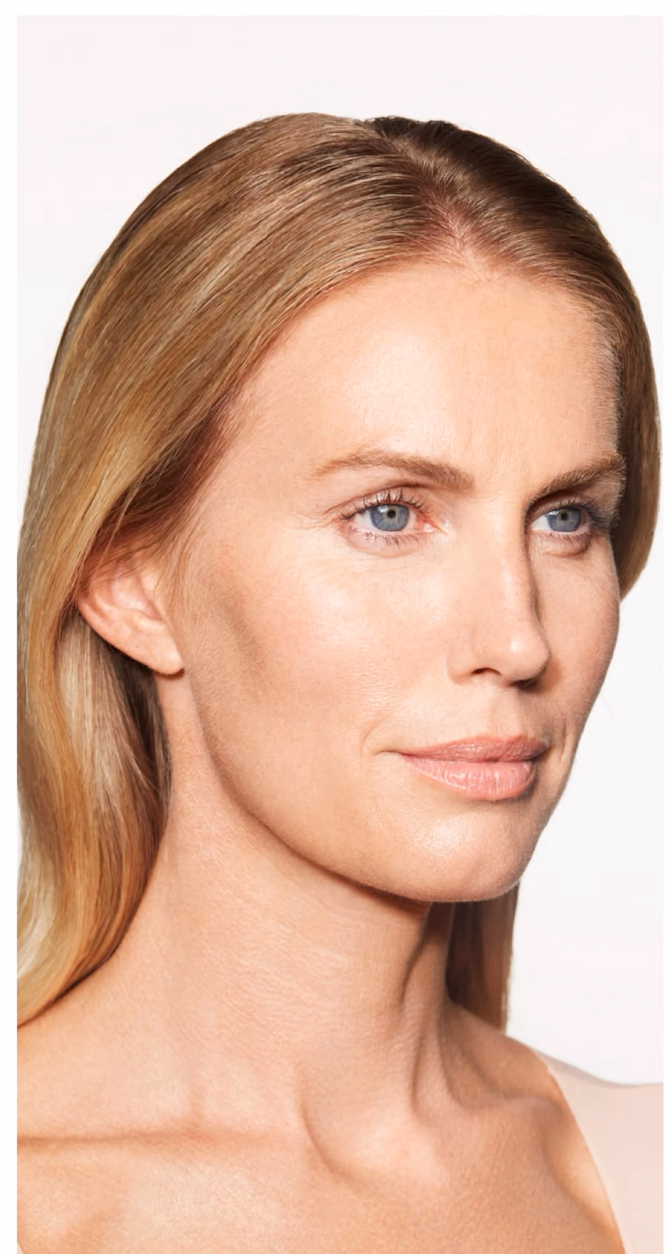 Botox treatment before.