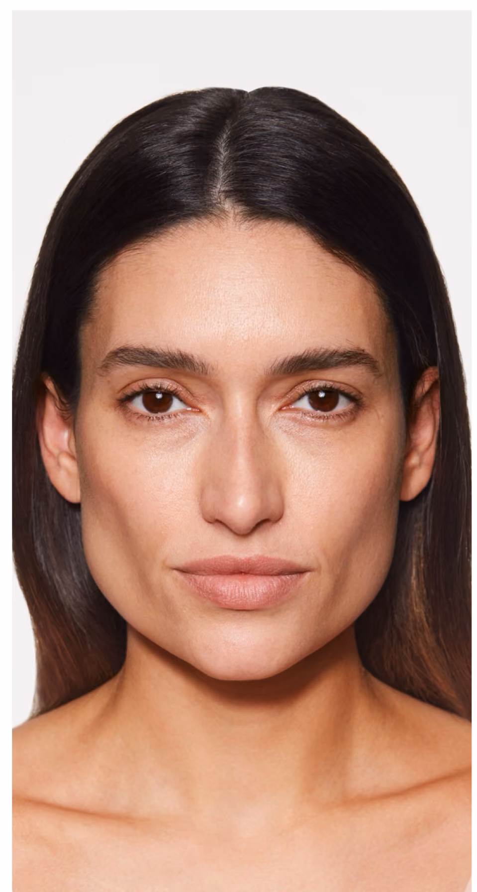 Dermal filler treatment before.