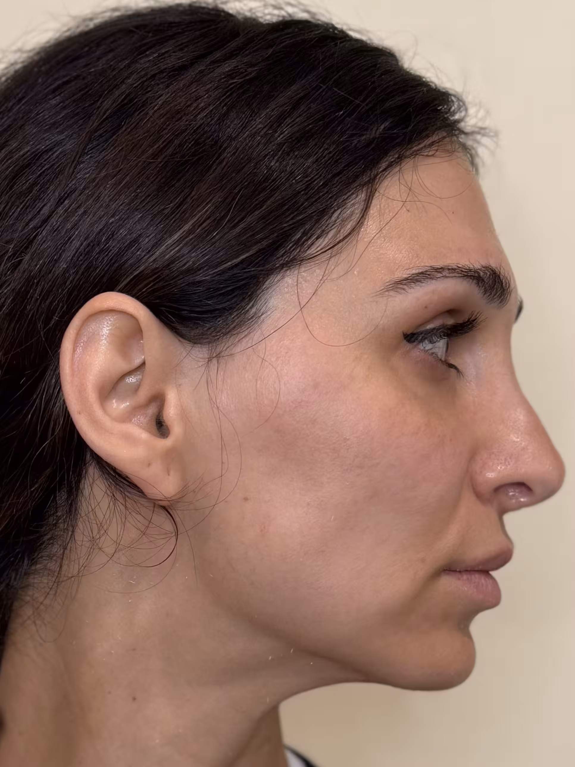 Microneedling treatment before.