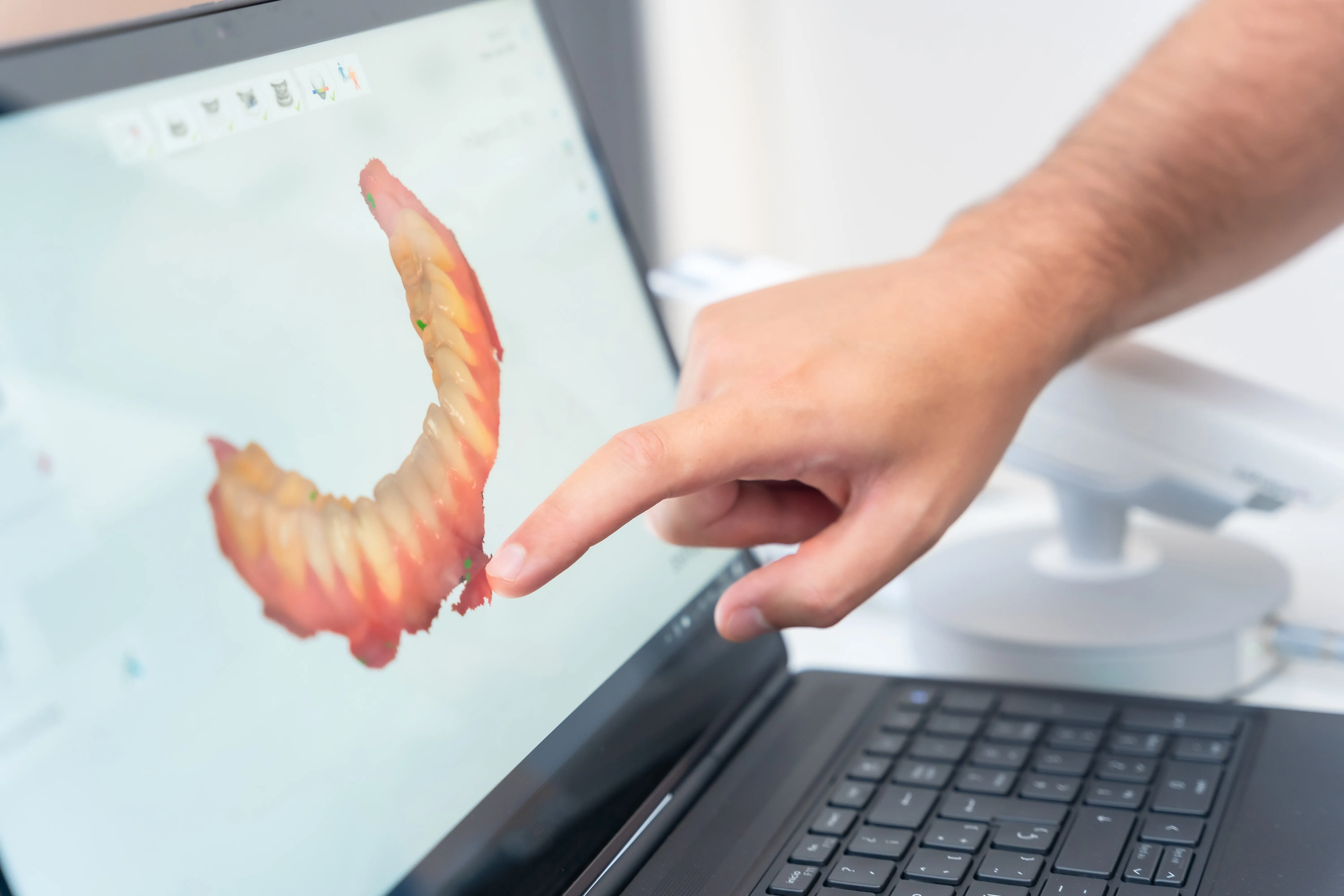 Hand pointing to a denture while reviewing an implant case