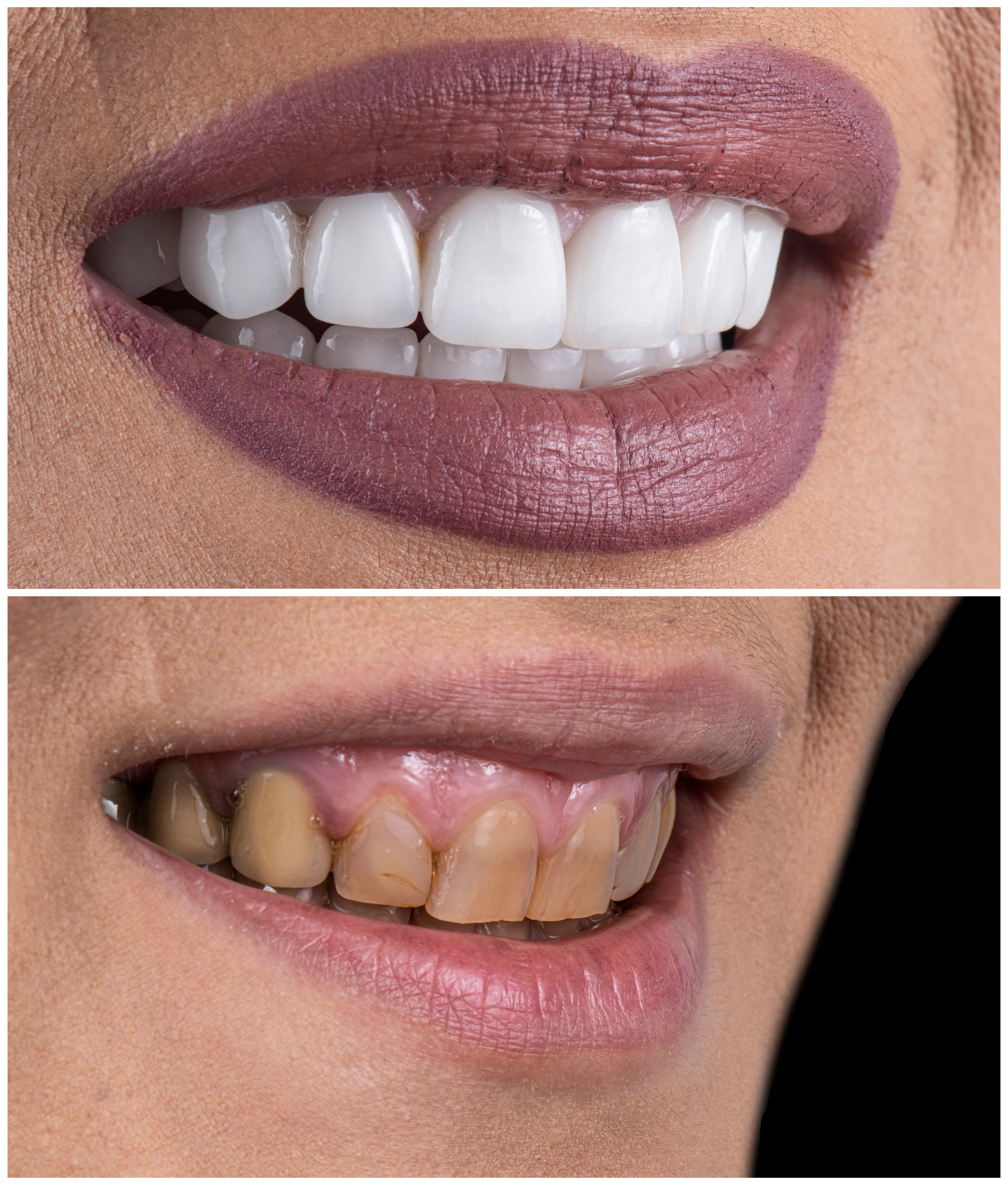 Before clinical photo showing discolored, worn, misaligned teeth requiring smile makeover restoration