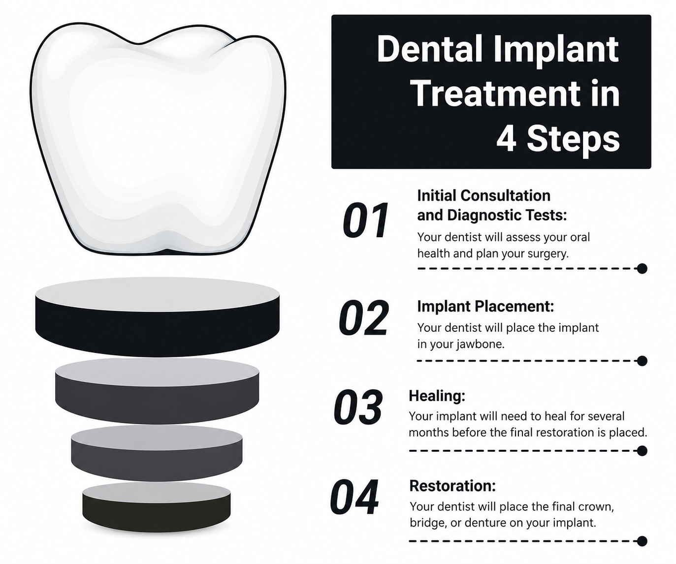 Step-by-step dental implant procedure illustration showing titanium post placement, abutment connection, and crown attachment