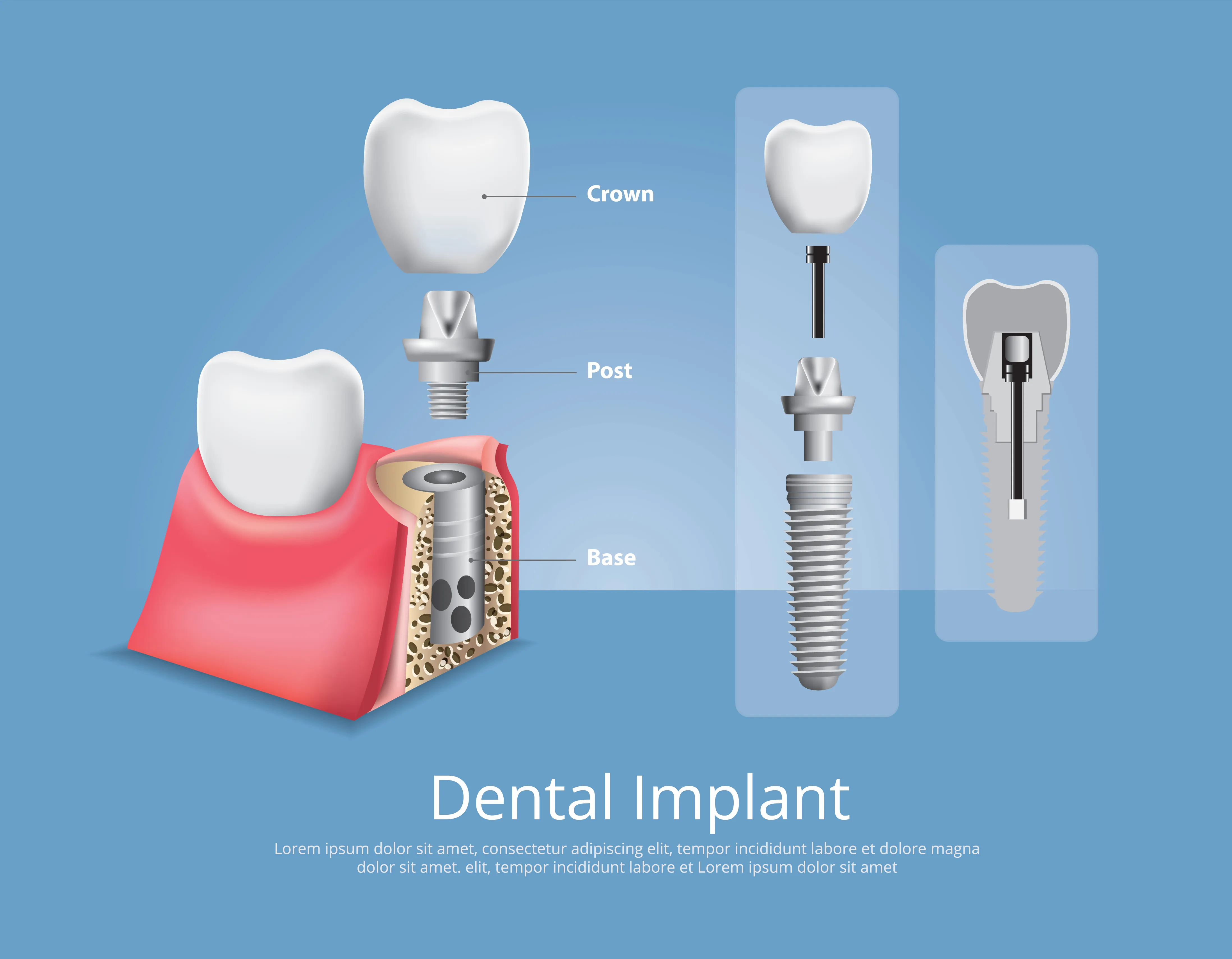 Single tooth implant component illustration showing titanium post, abutment, and ceramic crown restoration on blue background