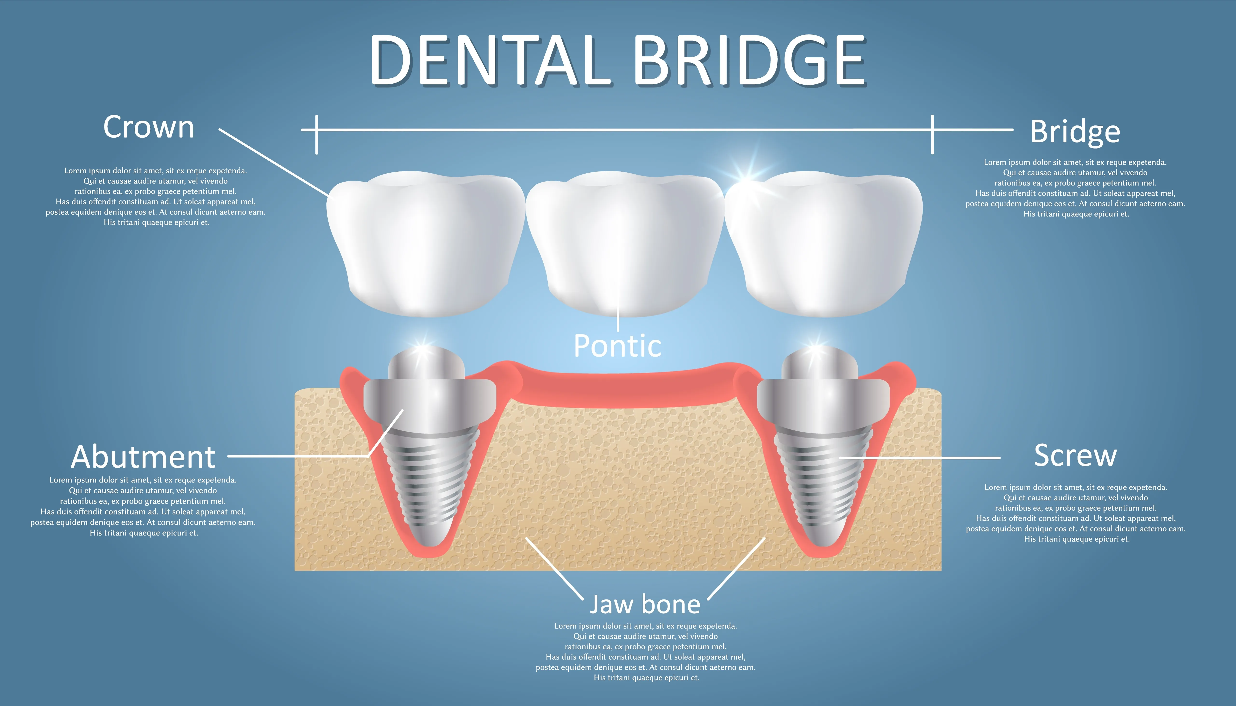 Dental implant bridge diagram on blue background showing implant post components and bridge restoration structure