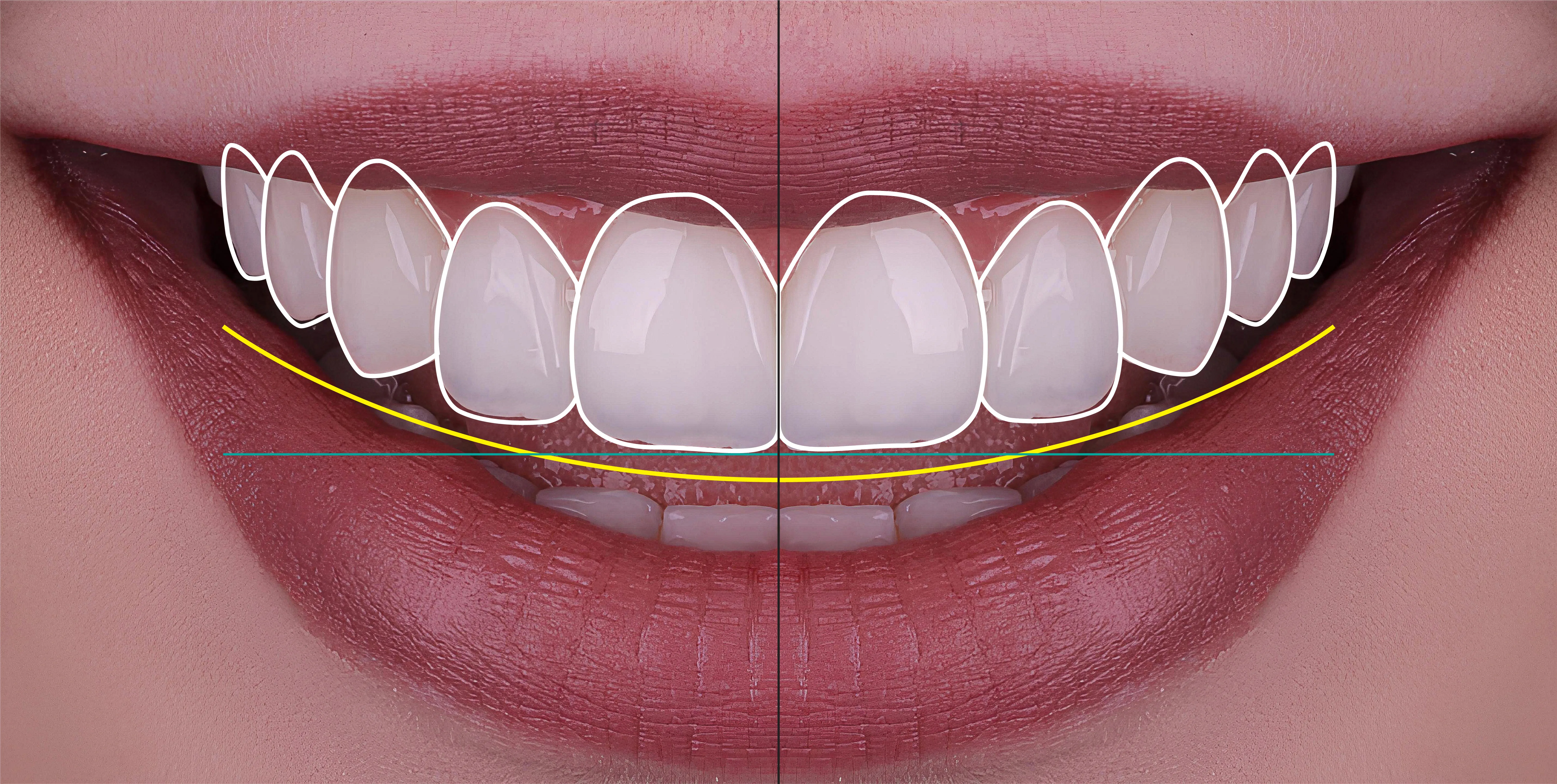 After photo showing polished, bright smile with aligned, whitened teeth demonstrating smile makeover results