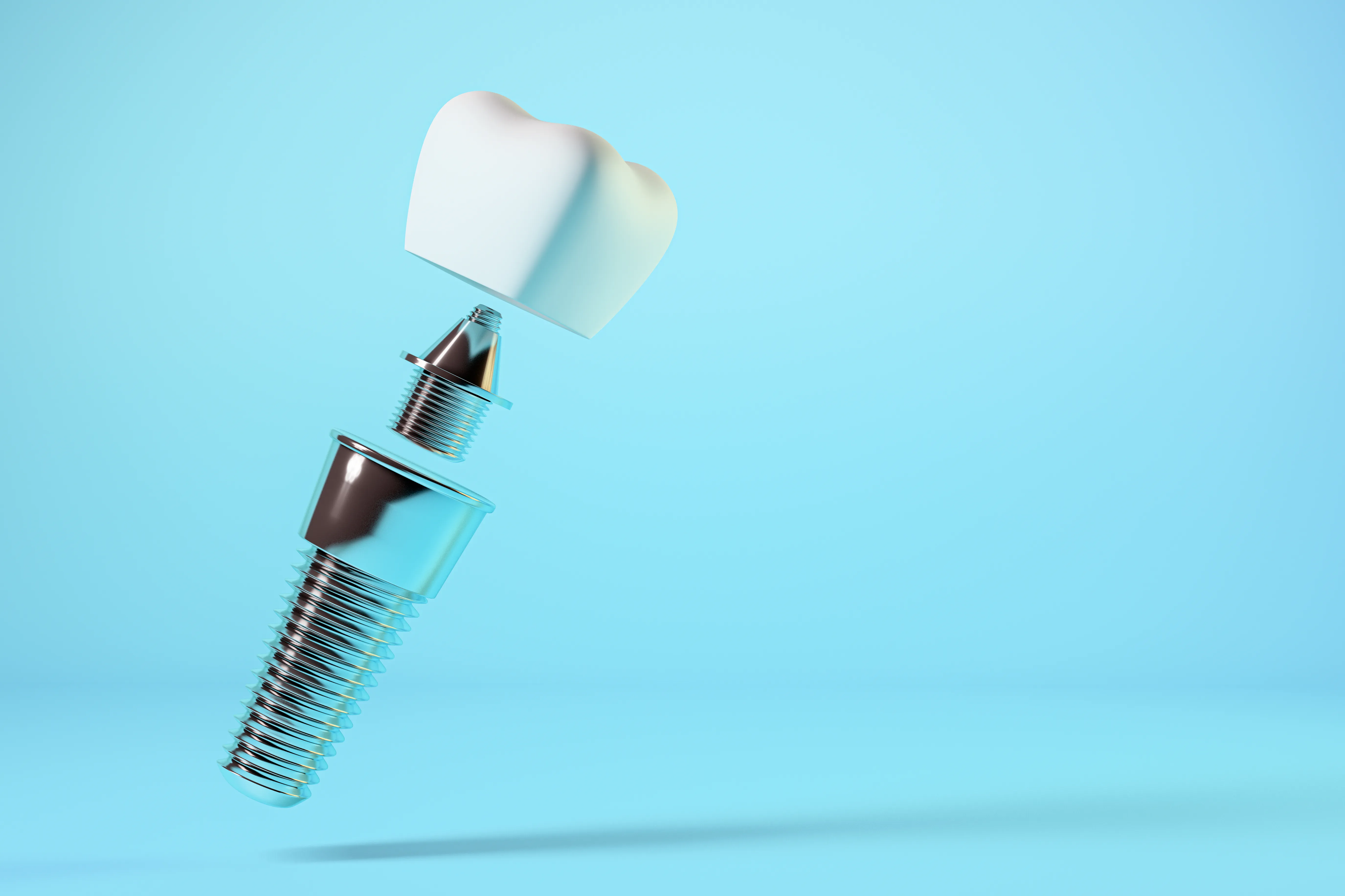 Exploded view of a dental implant, abutment, and crown