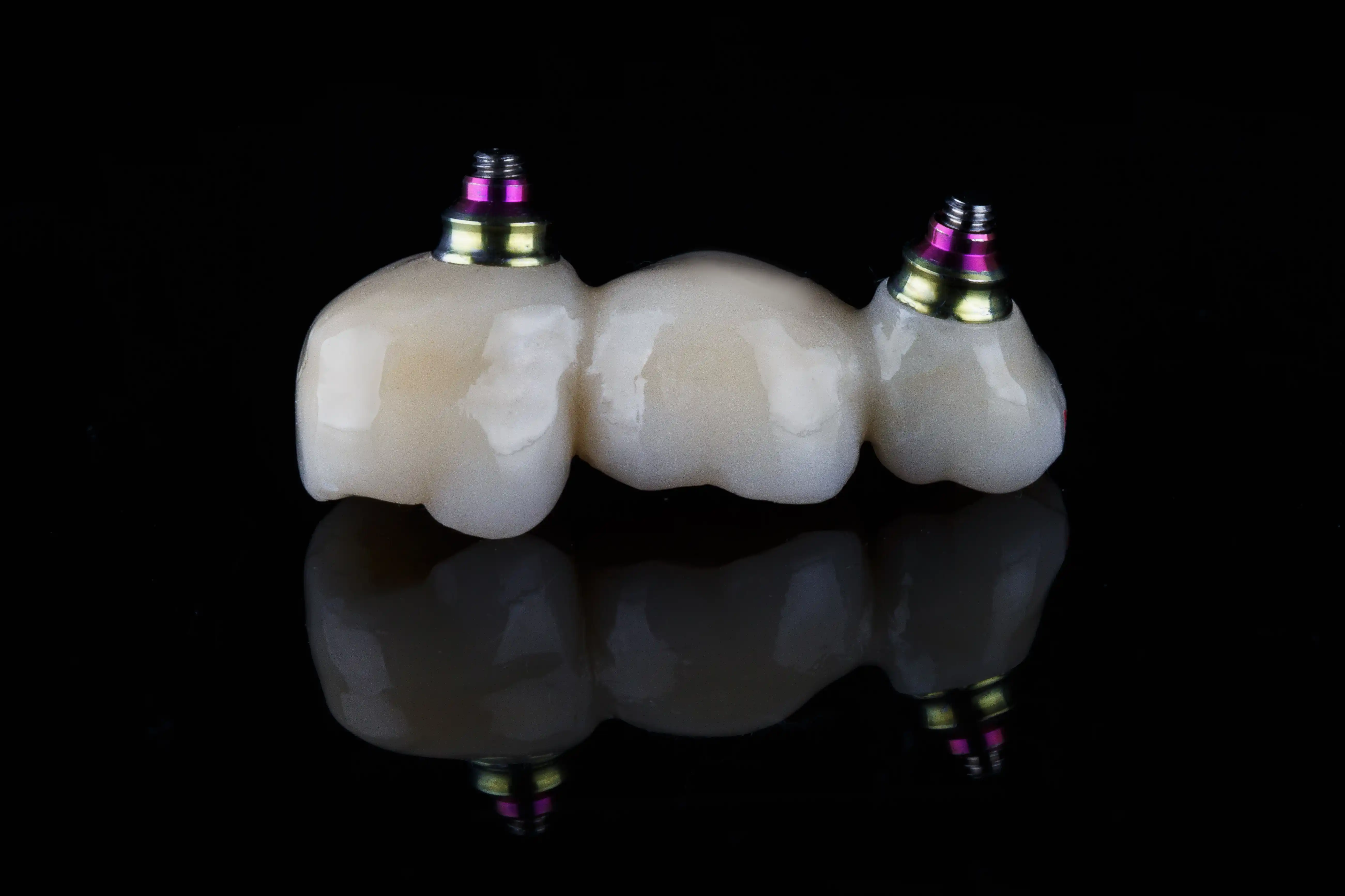 3D model on black background showing multiple implant posts with bridge prosthetic spanning across them