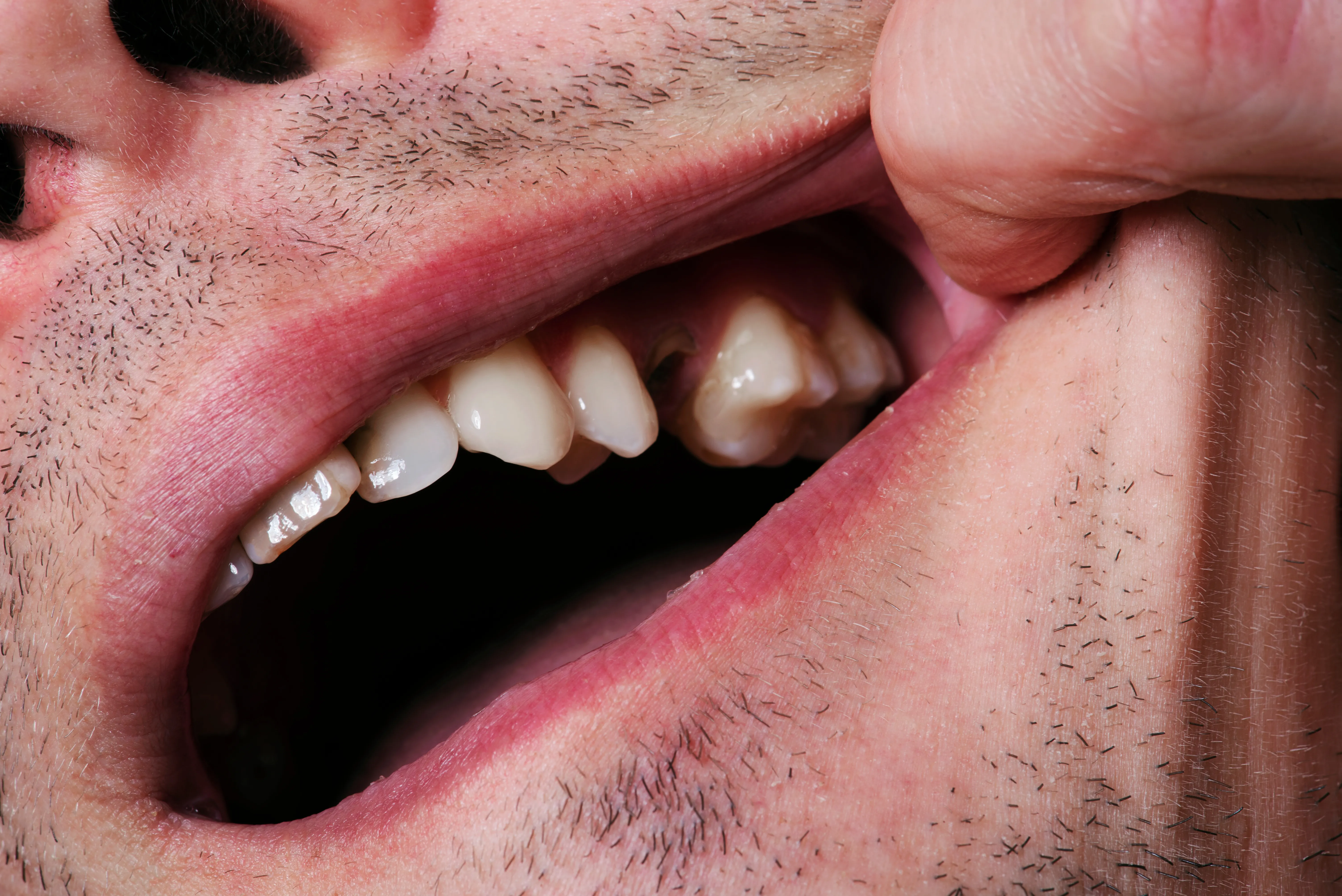 Clinical before photo showing missing single tooth gap in smile requiring implant replacement
