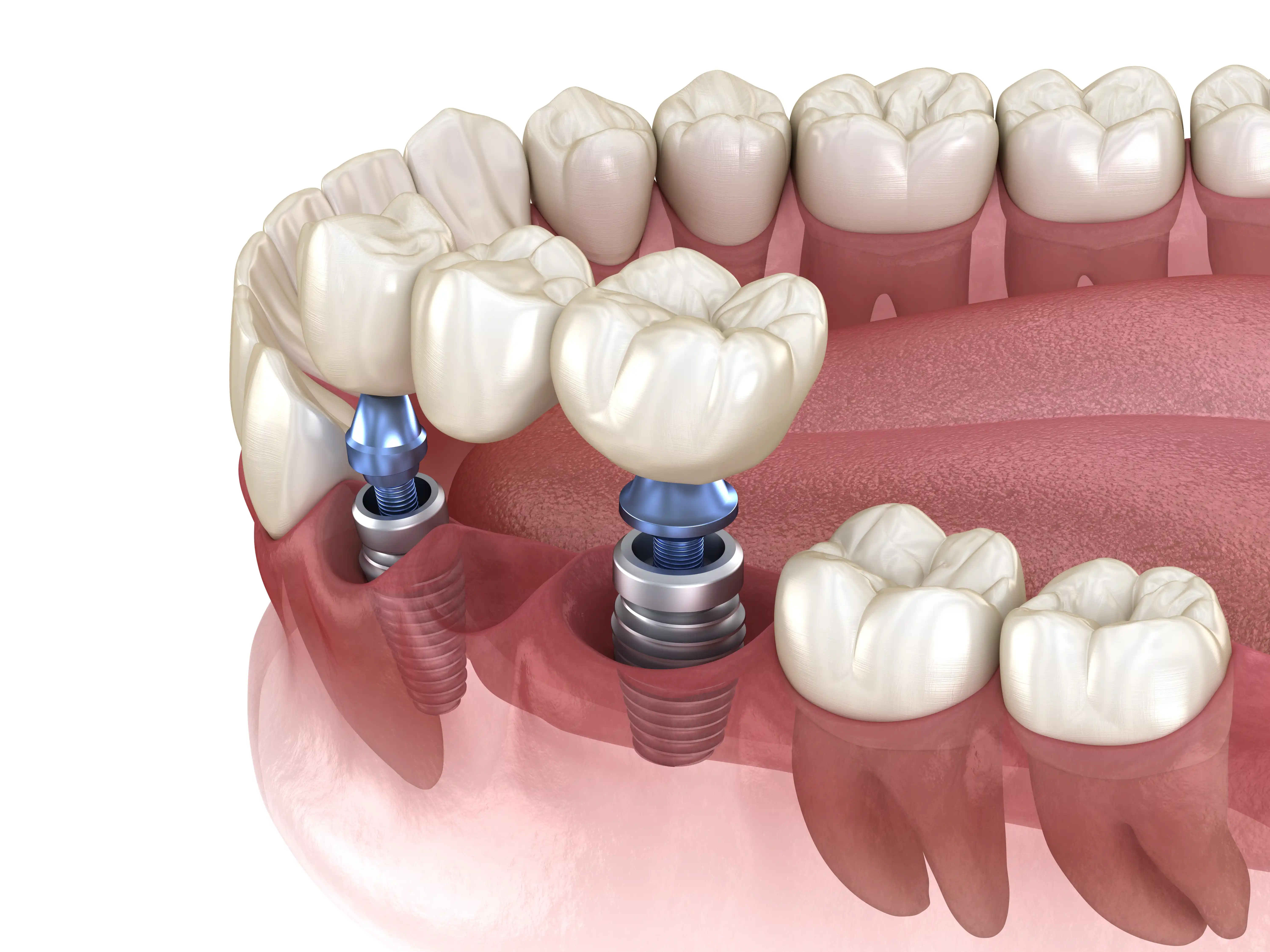 Implant Bridges