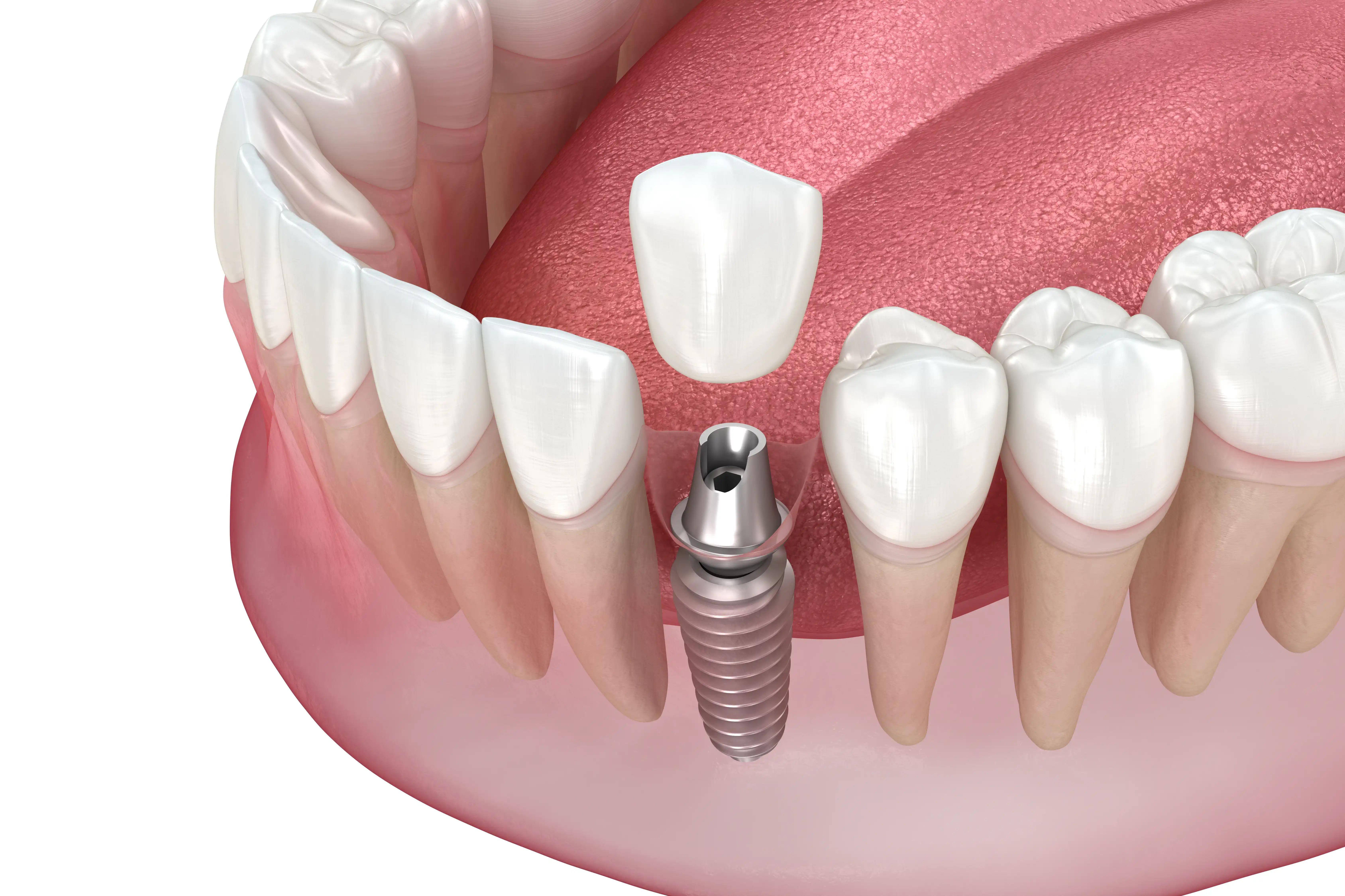 Patient smiling after single tooth implant treatment