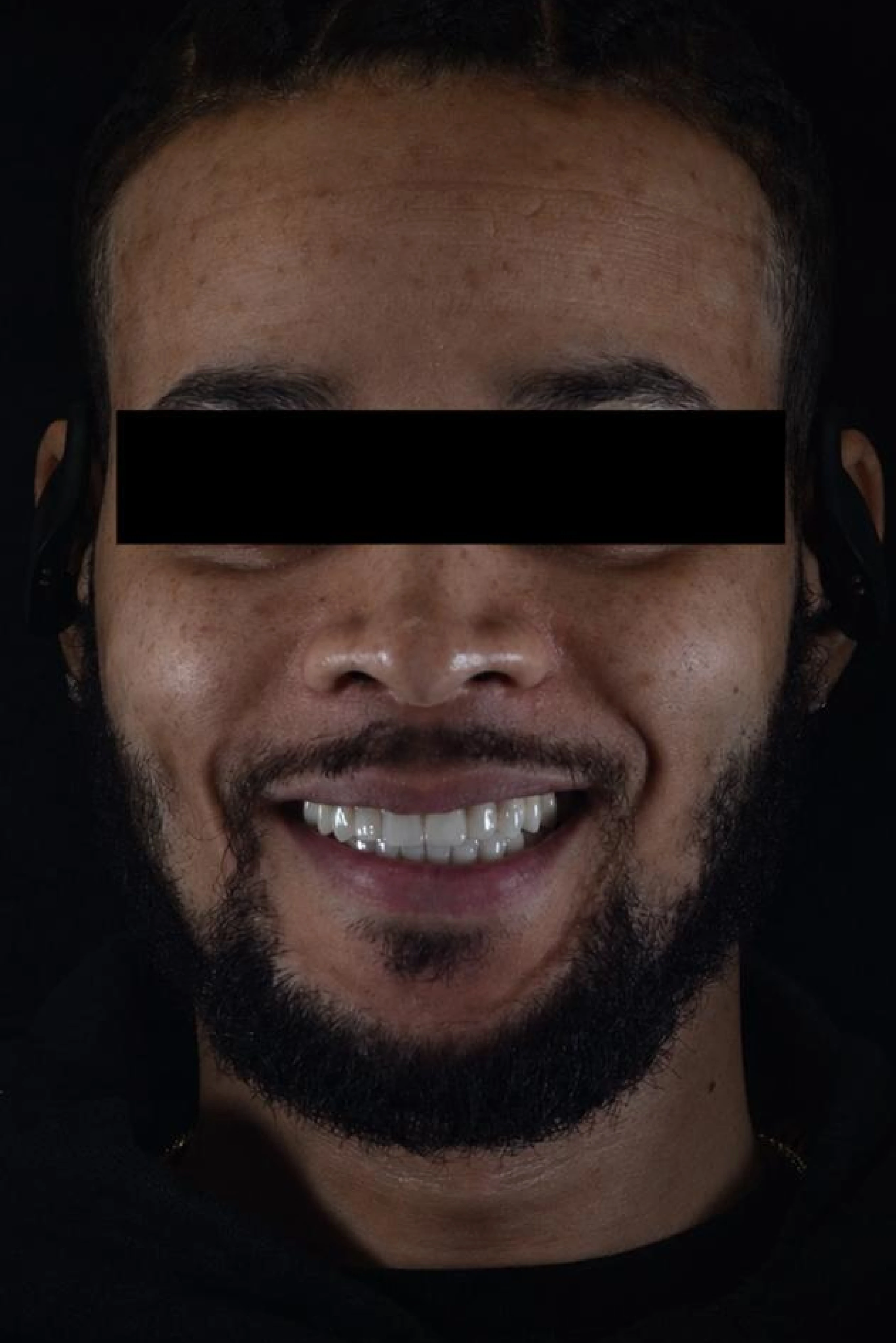 Patient one after dental implant treatment
