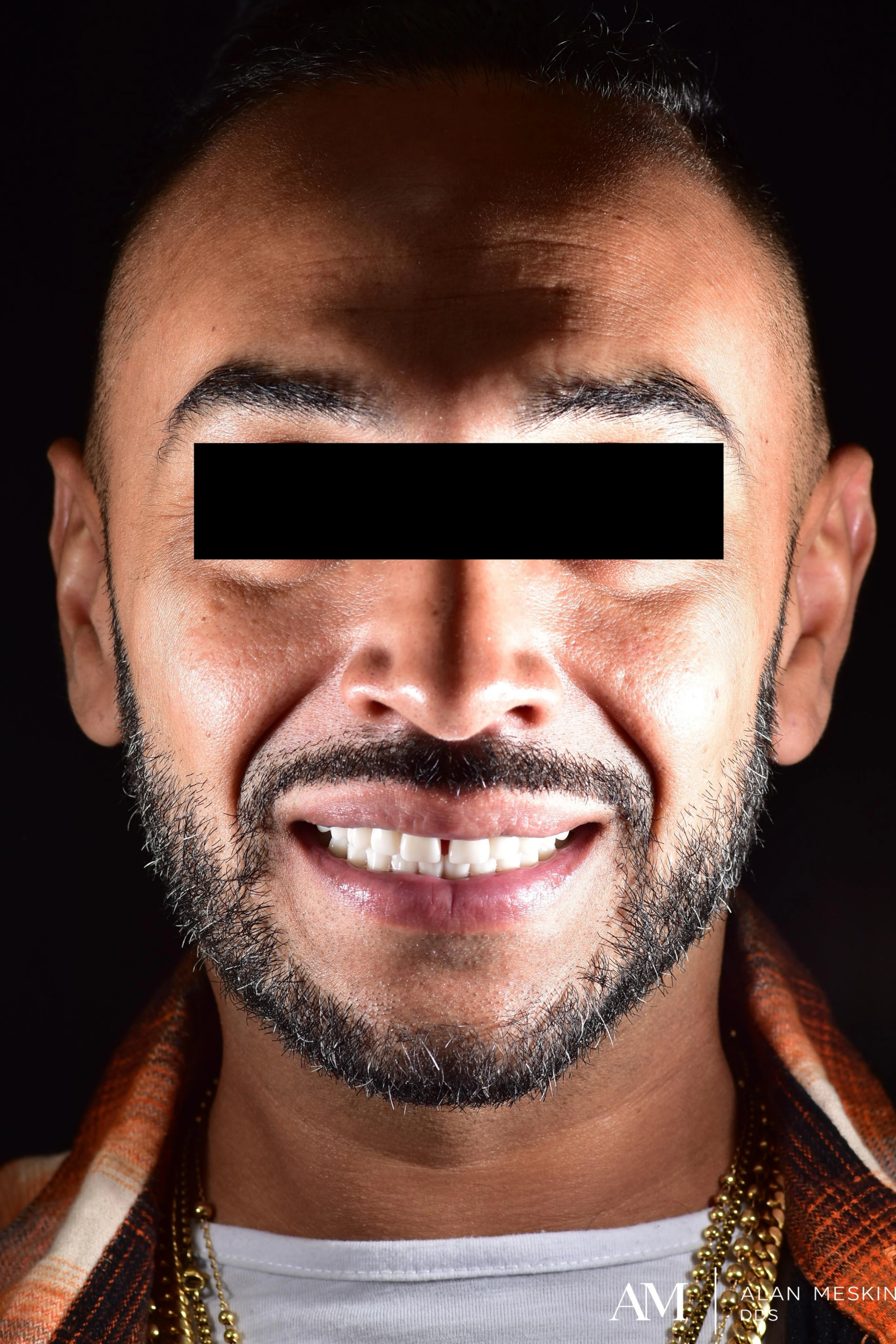 Patient two after dental implant treatment