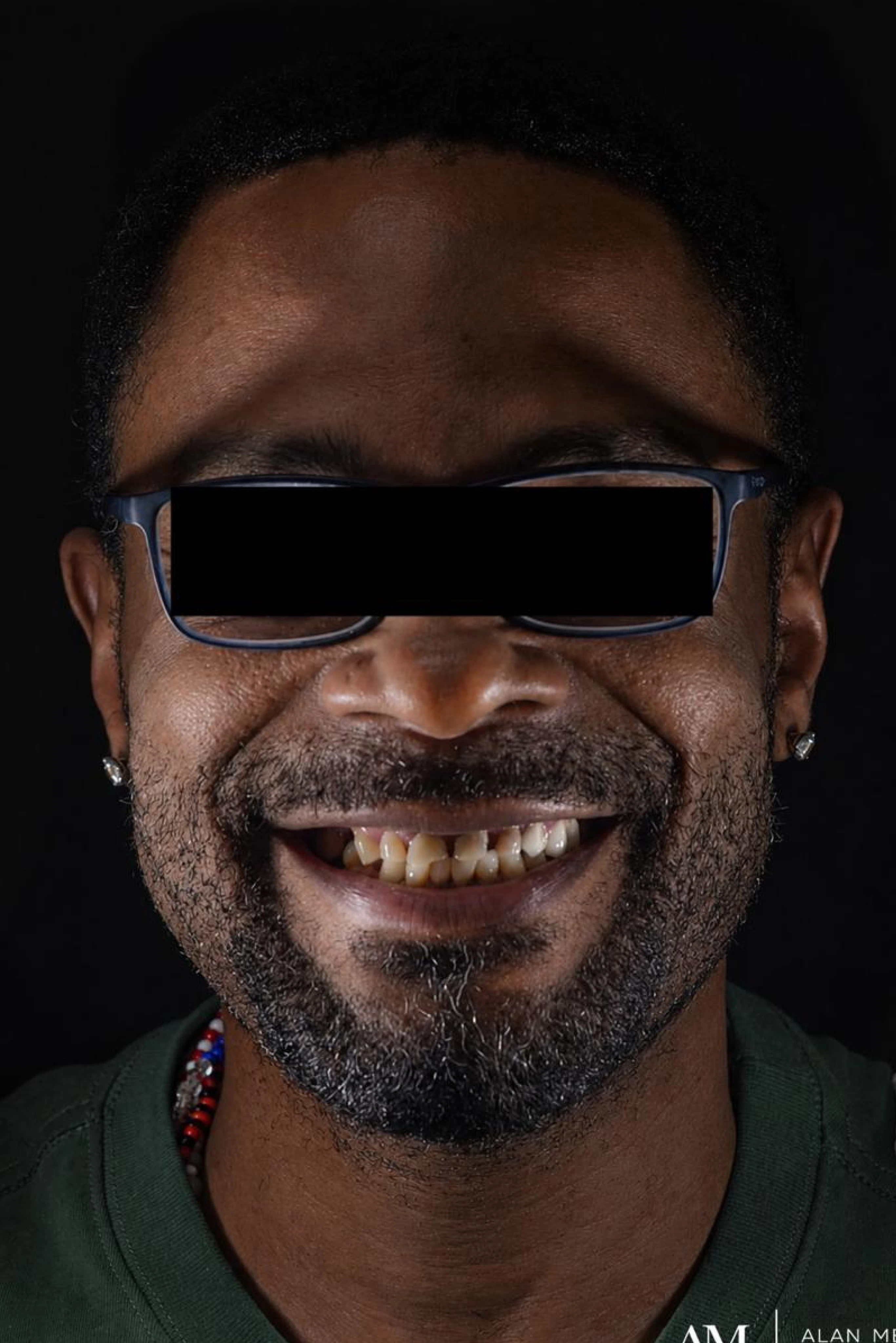 Patient three before dental implant treatment