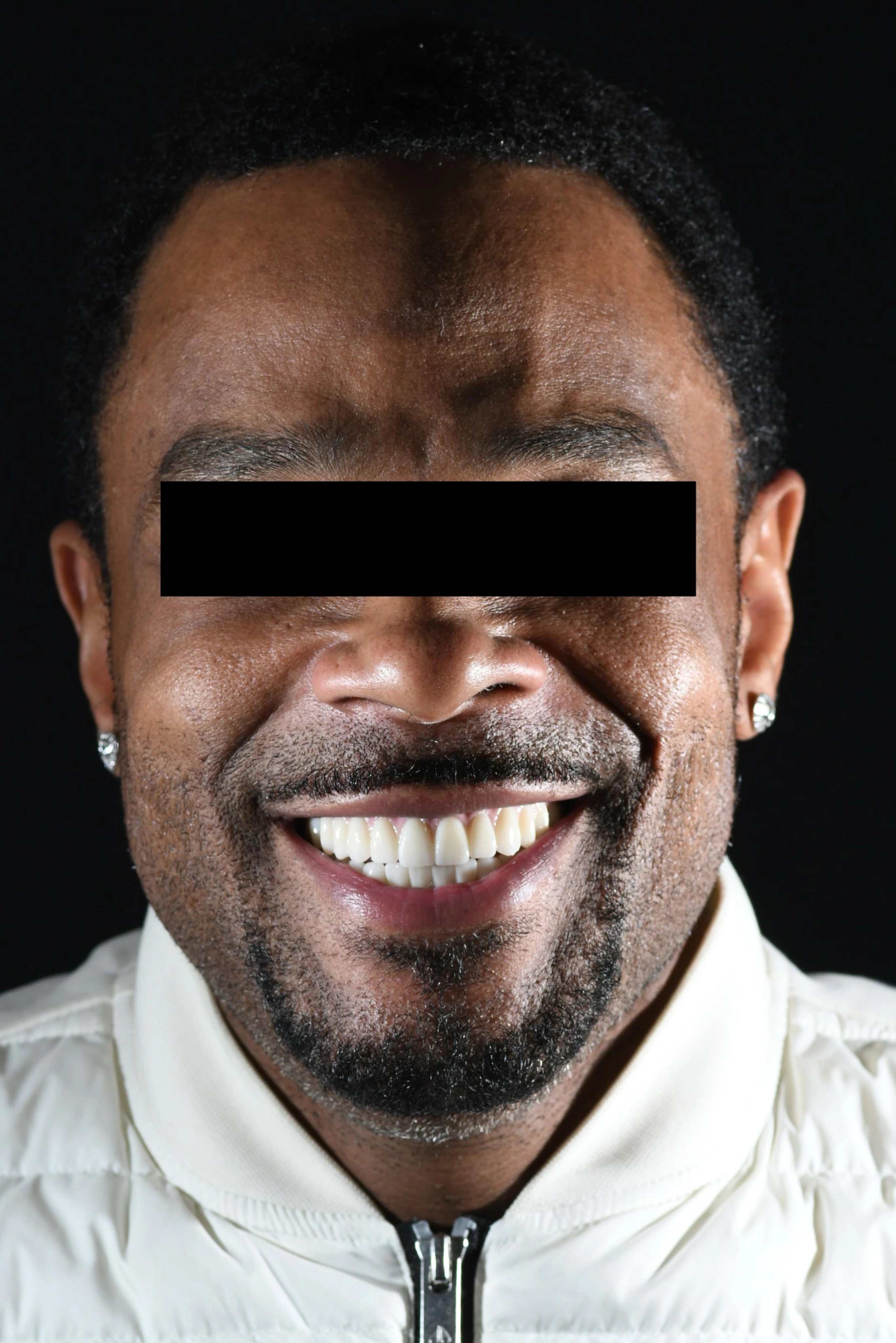 Patient three after dental implant treatment