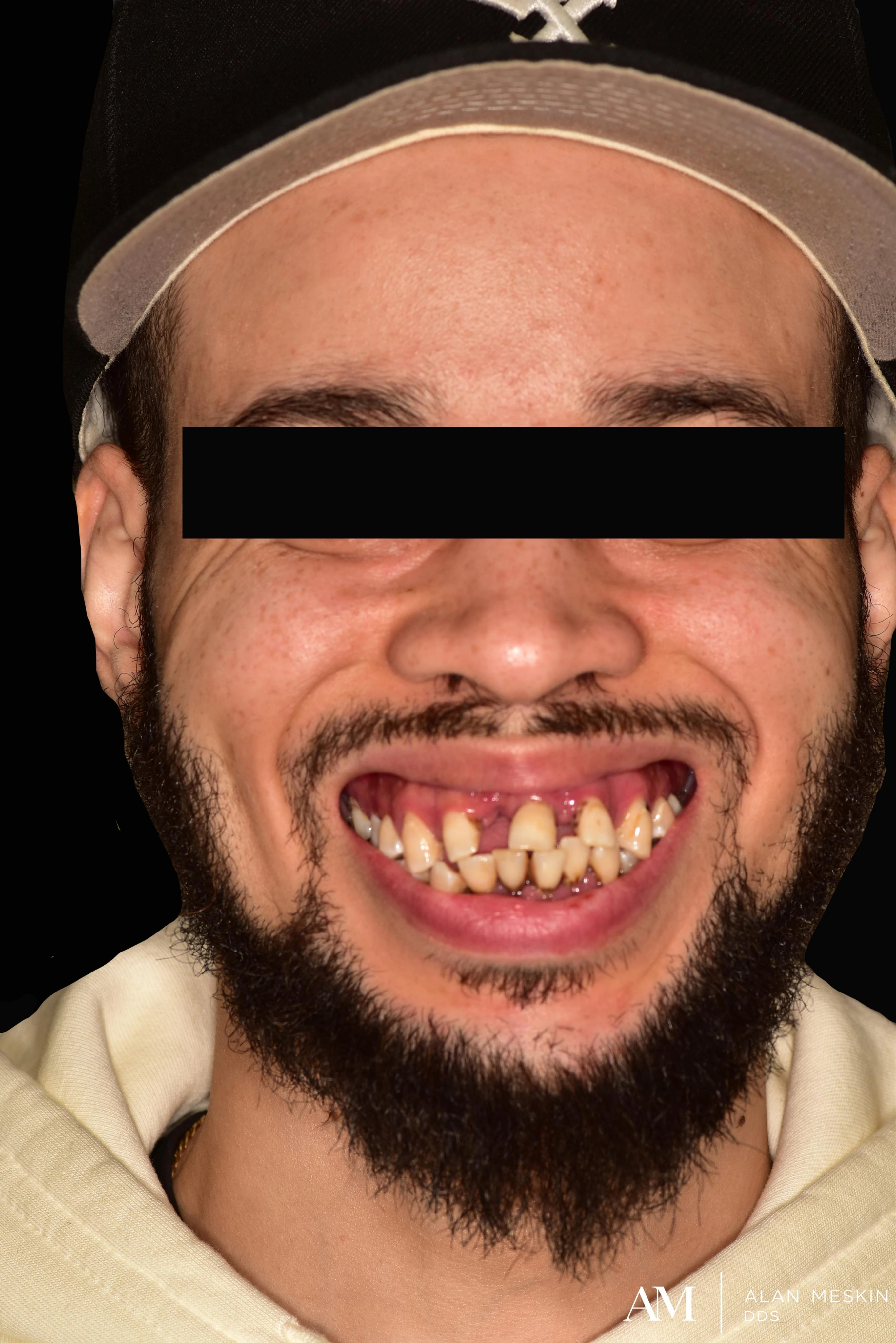 Patient one before dental implant treatment