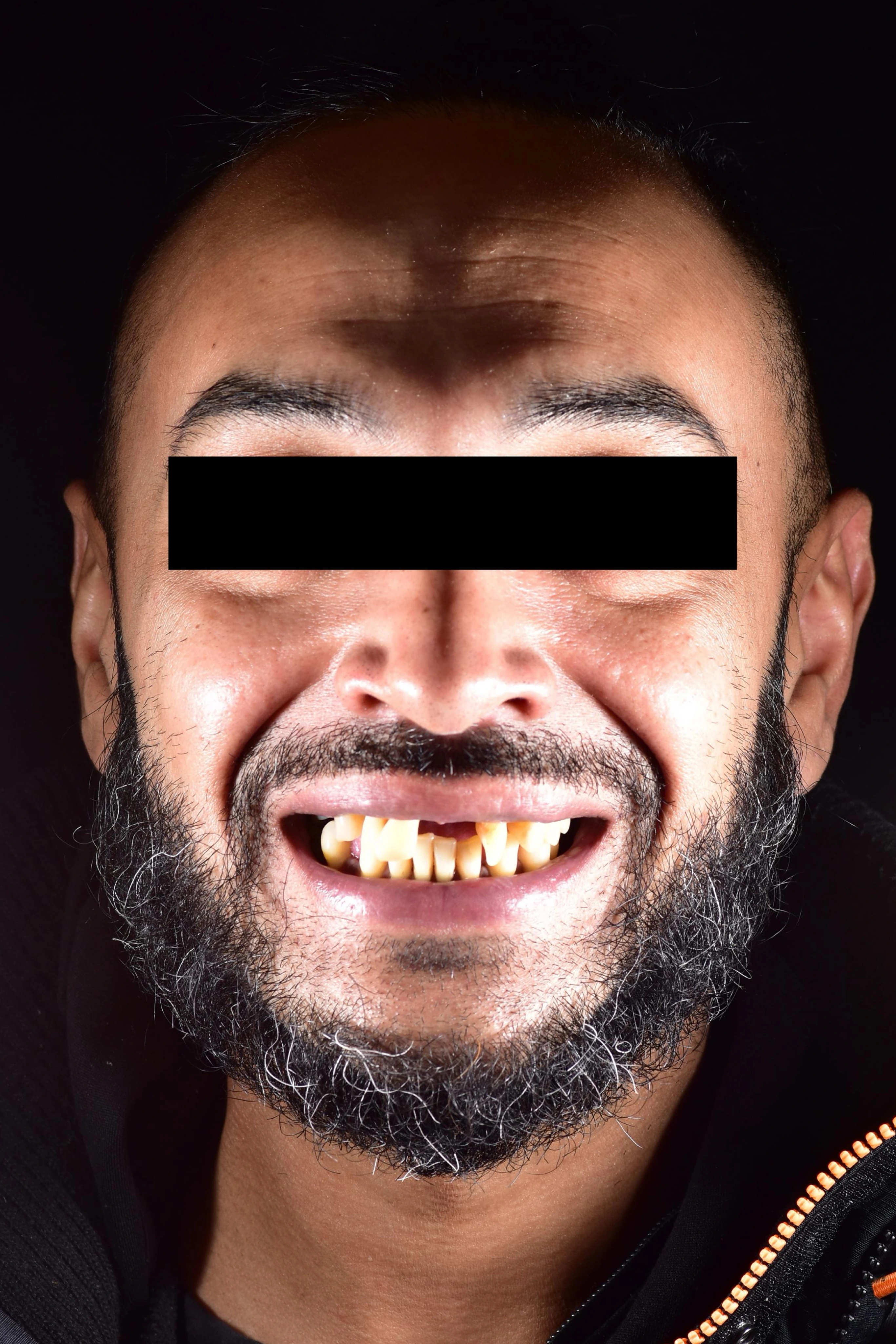 Patient two before dental implant treatment