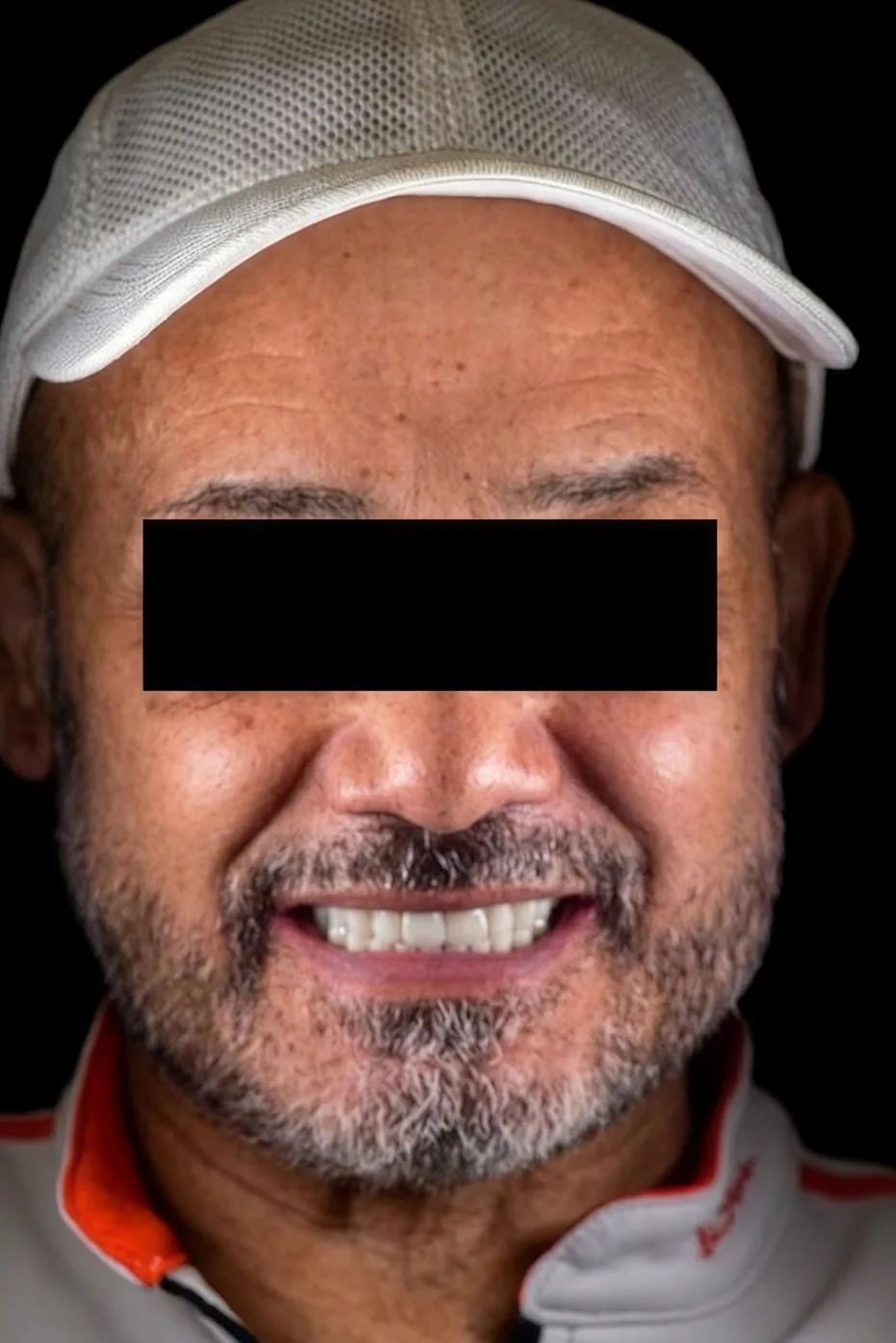 Patient four after dental implant treatment