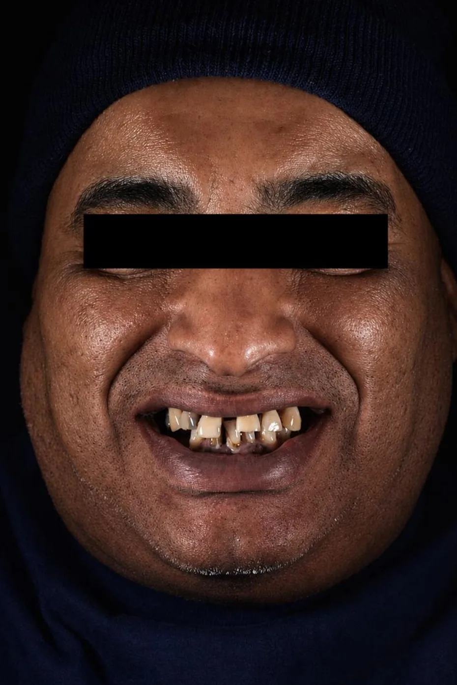 Patient five before dental implant treatment