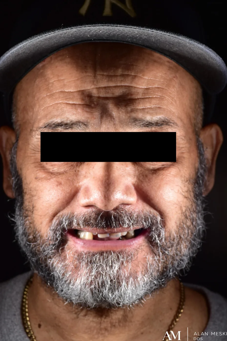 Patient four before dental implant treatment