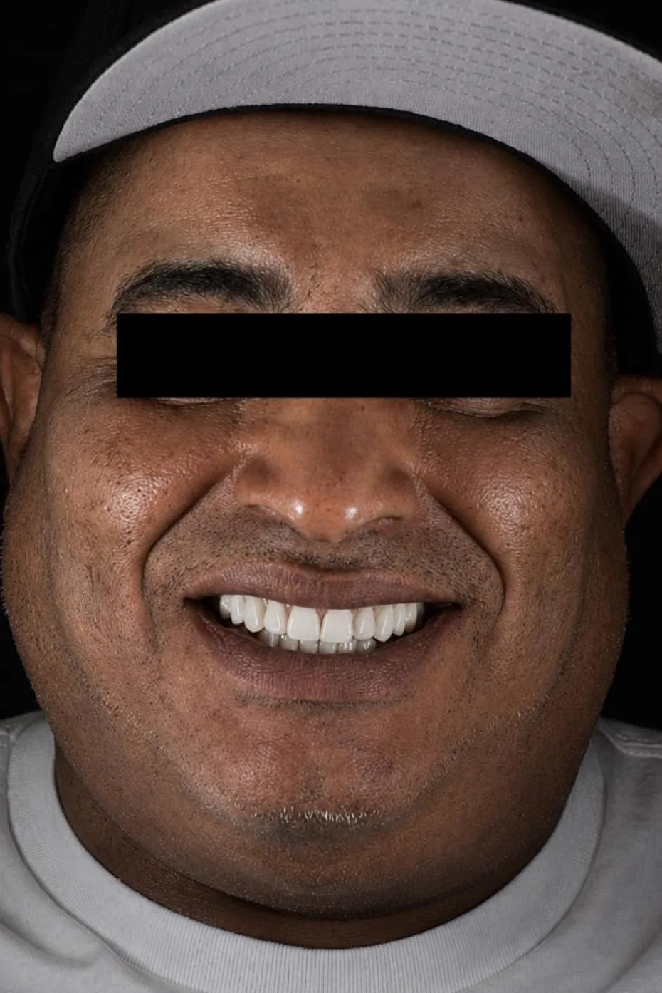 Patient five after dental implant treatment