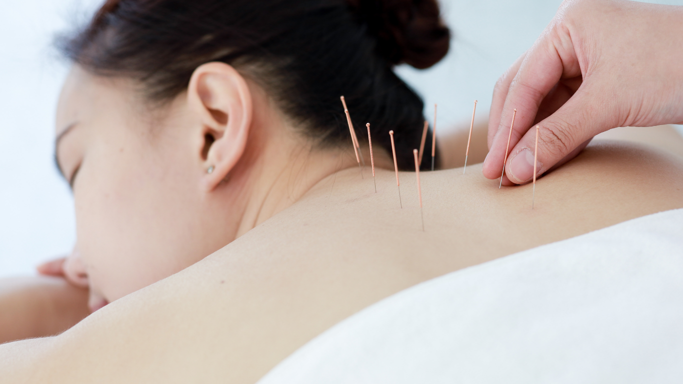 acupuncture in aiea, hi
