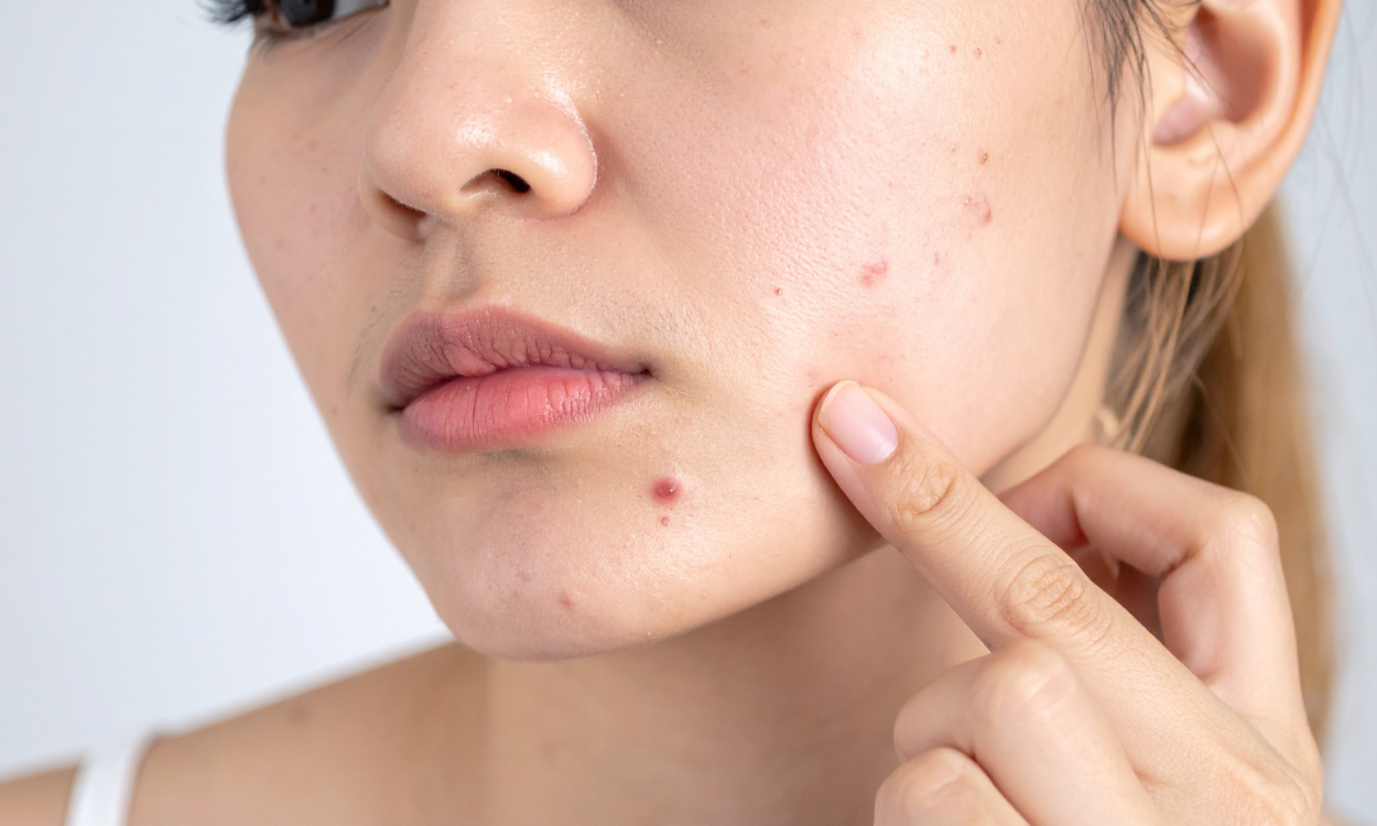 acupuncture for acne aiea, hi
