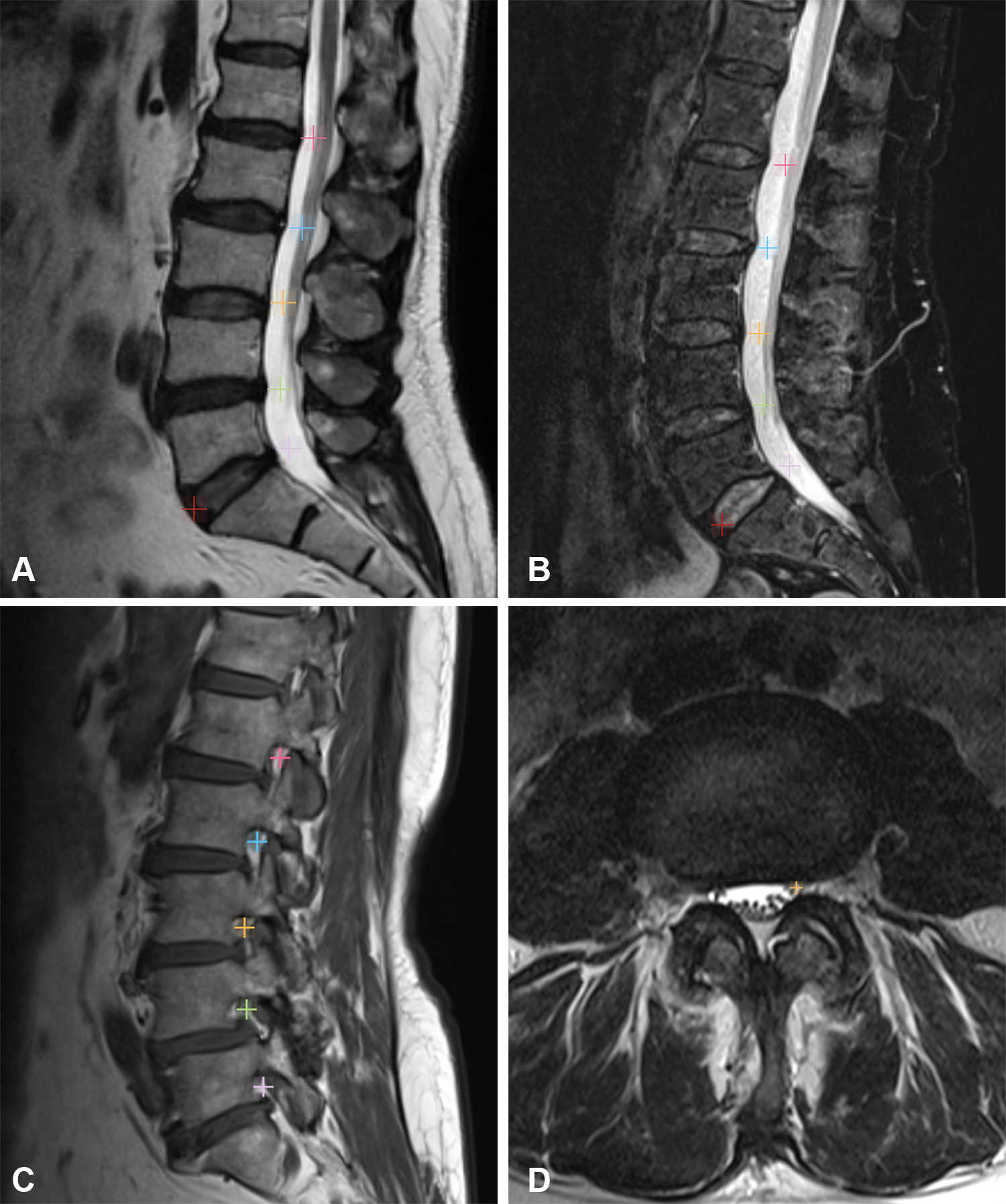 MR images in (A) sagittal T2-weighted and (B) sagittal STIR views demonstrate the location of the localizers within the