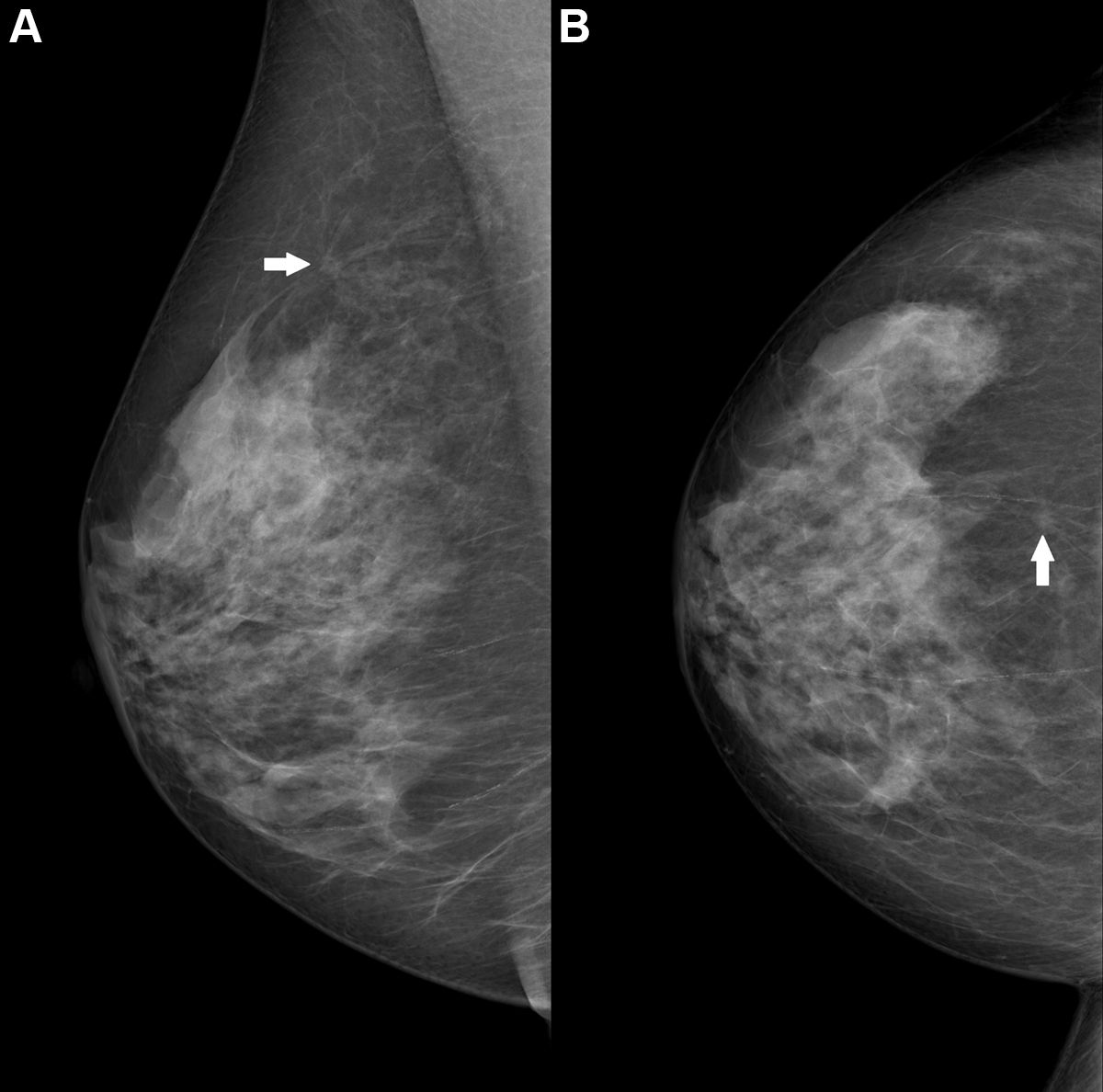 Right breast mammogram in a 69-year-old woman. There is a 6-mm spiculate mass in the 12 o'clock position (arrow), visibl