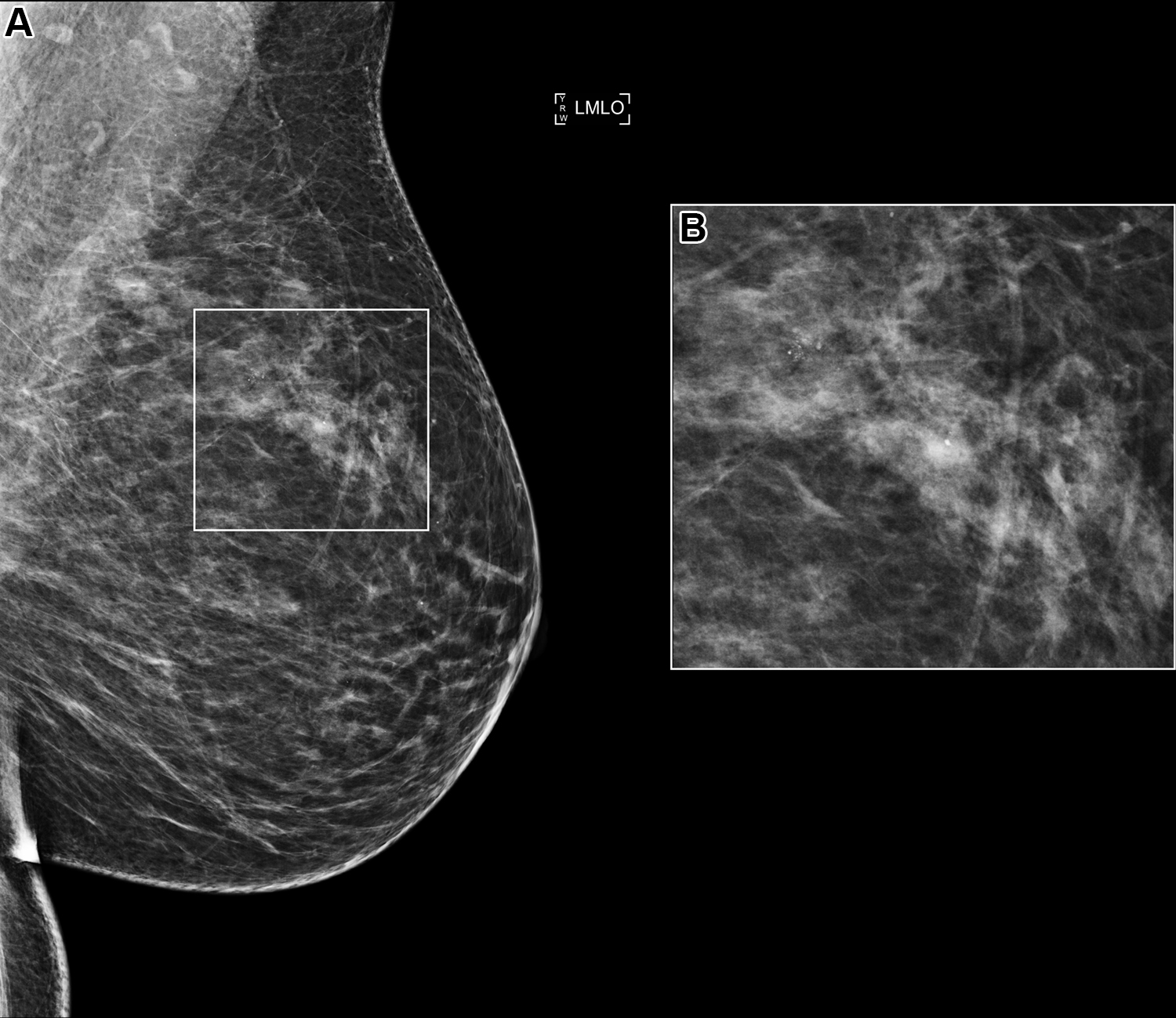 (A) Left mediolateral oblique (LMLO) mammogram in a 58-year-old woman with an area of microcalcification (box). (B) Magn