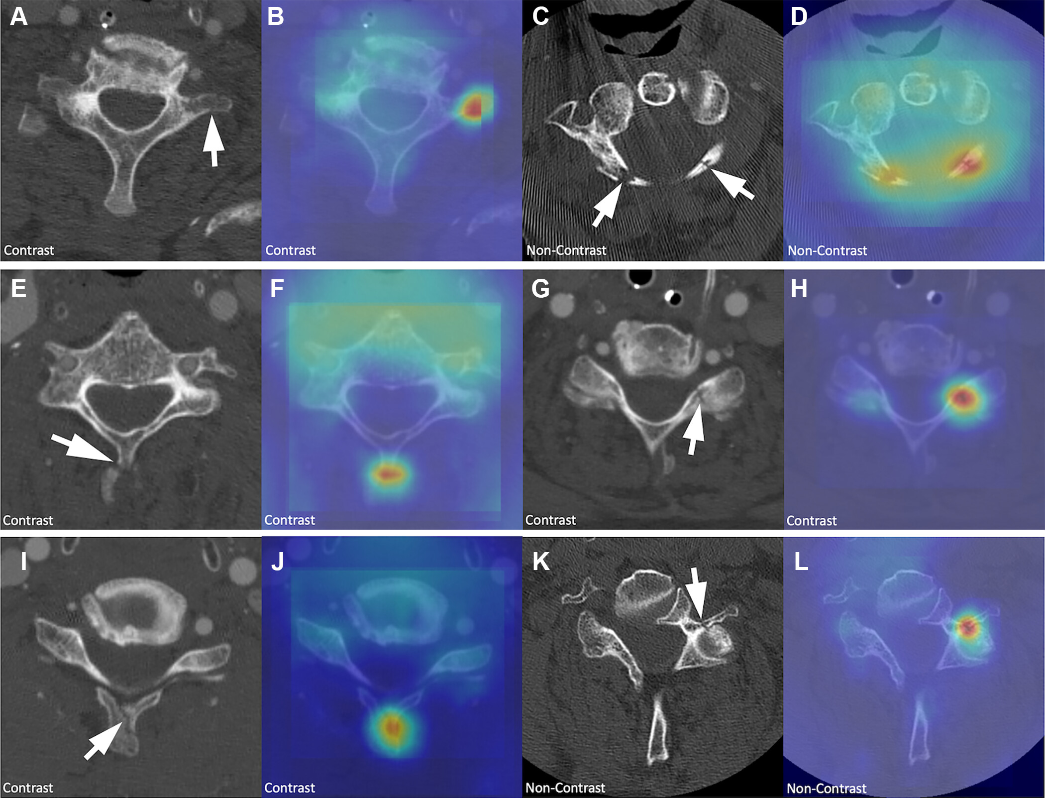Example cases of fractures identified by the machine learning models but missed by reporting radiologists. Axial CT imag