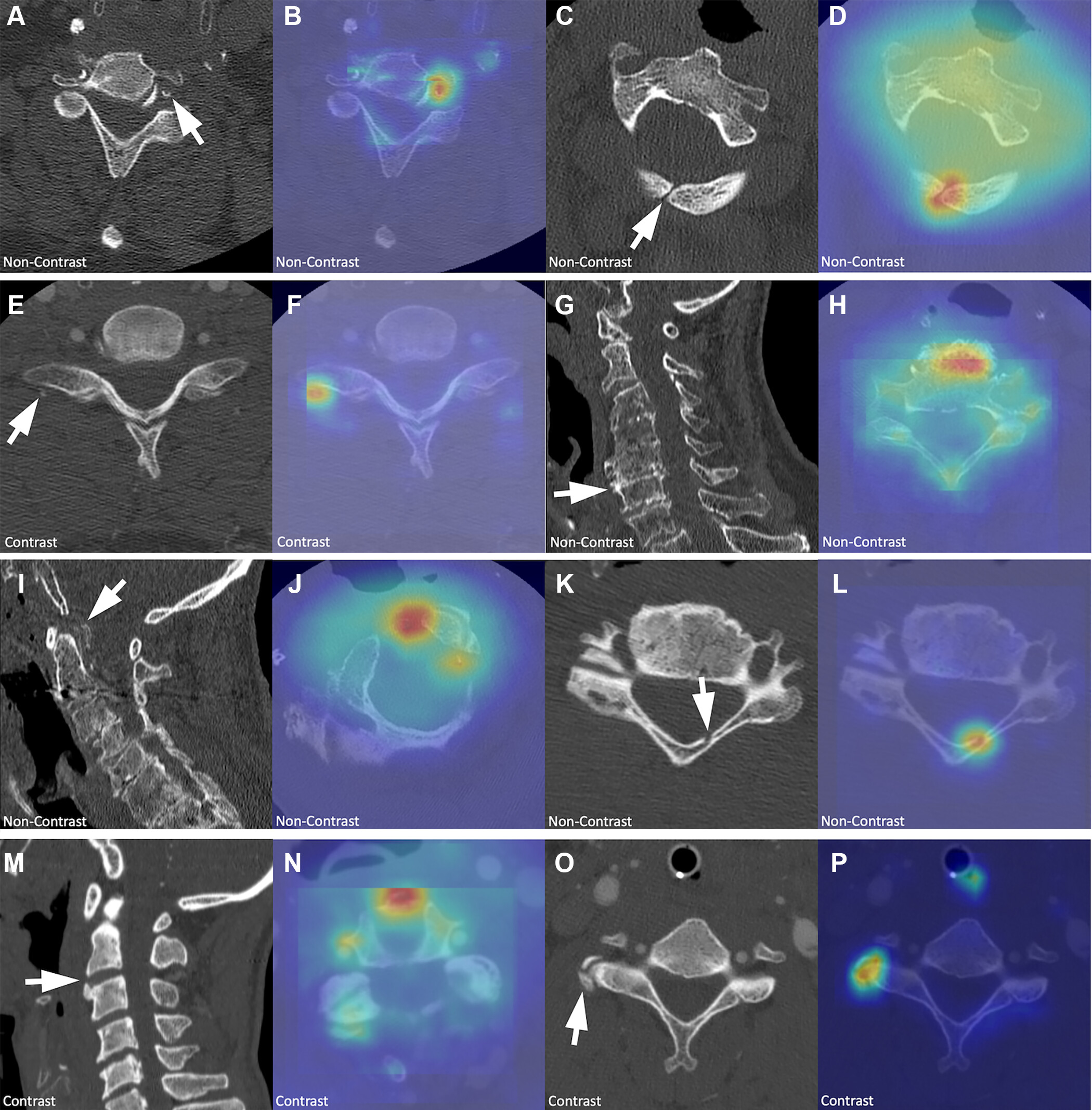 Example cases in the false-positive group incorrectly identified as fractures by the machine learning models. The CT ima