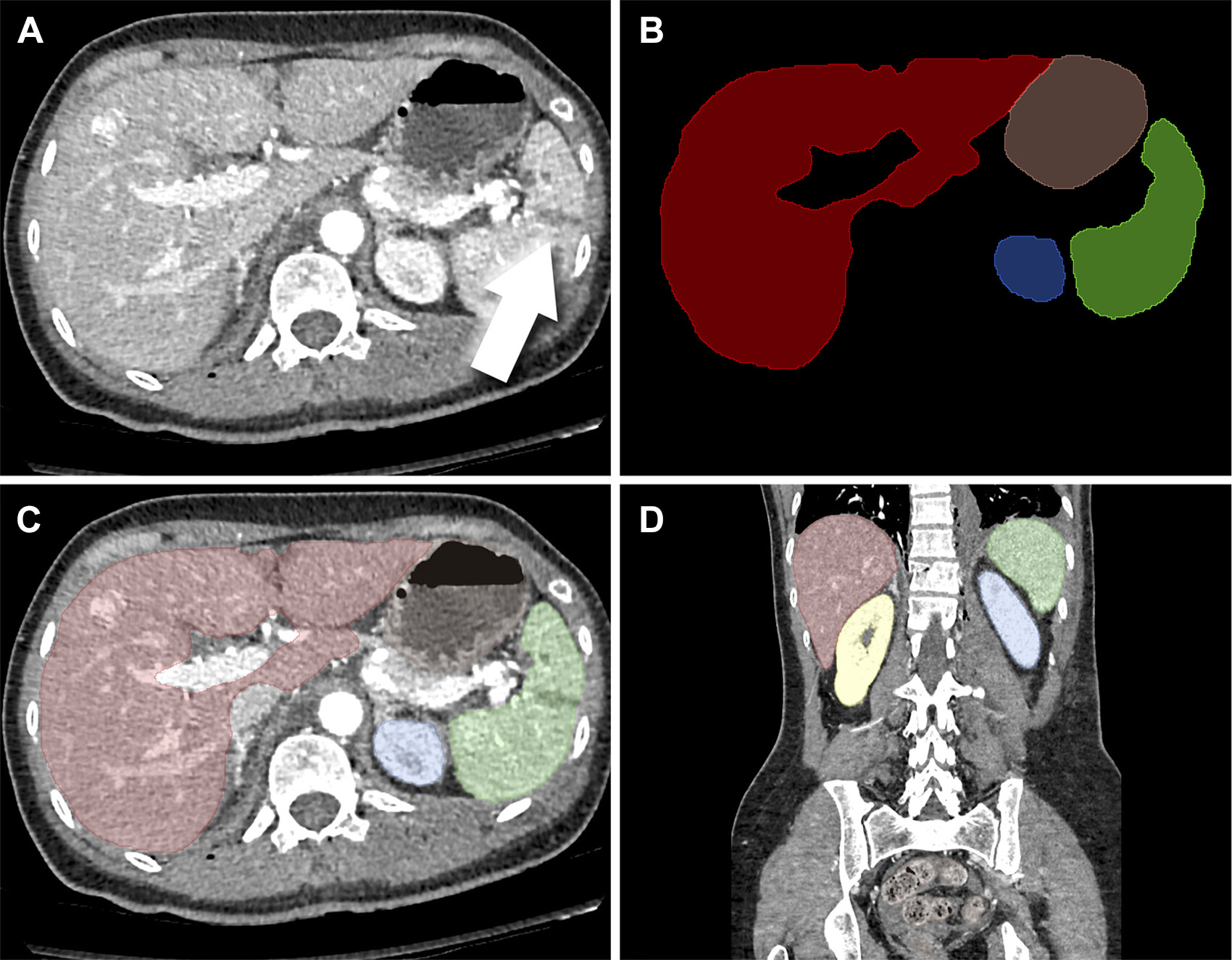 Example of abdominal organ segmentation, with each color representing different organs. (A) Axial CT DICOM image demonst
