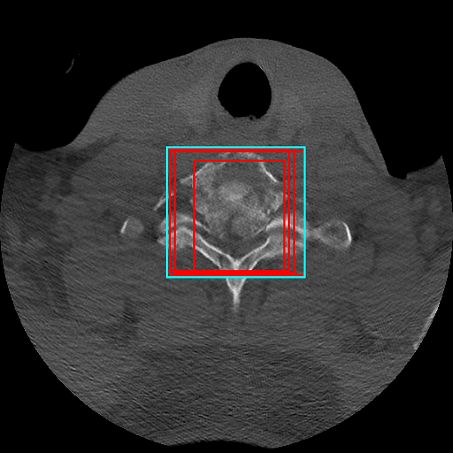 Axial noncontrast cervical spine CT image with bounding boxes surrounding the fractured vertebrae, annotated by individu