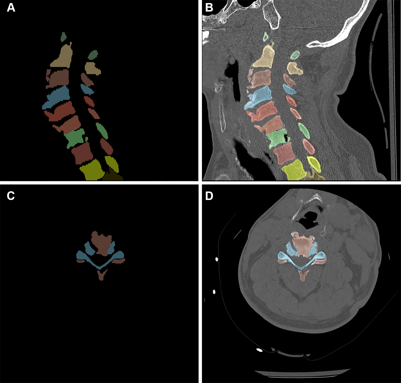 Example of cervical spine segmentation, with each color representing different vertebrae levels. (A) Image illustrates t