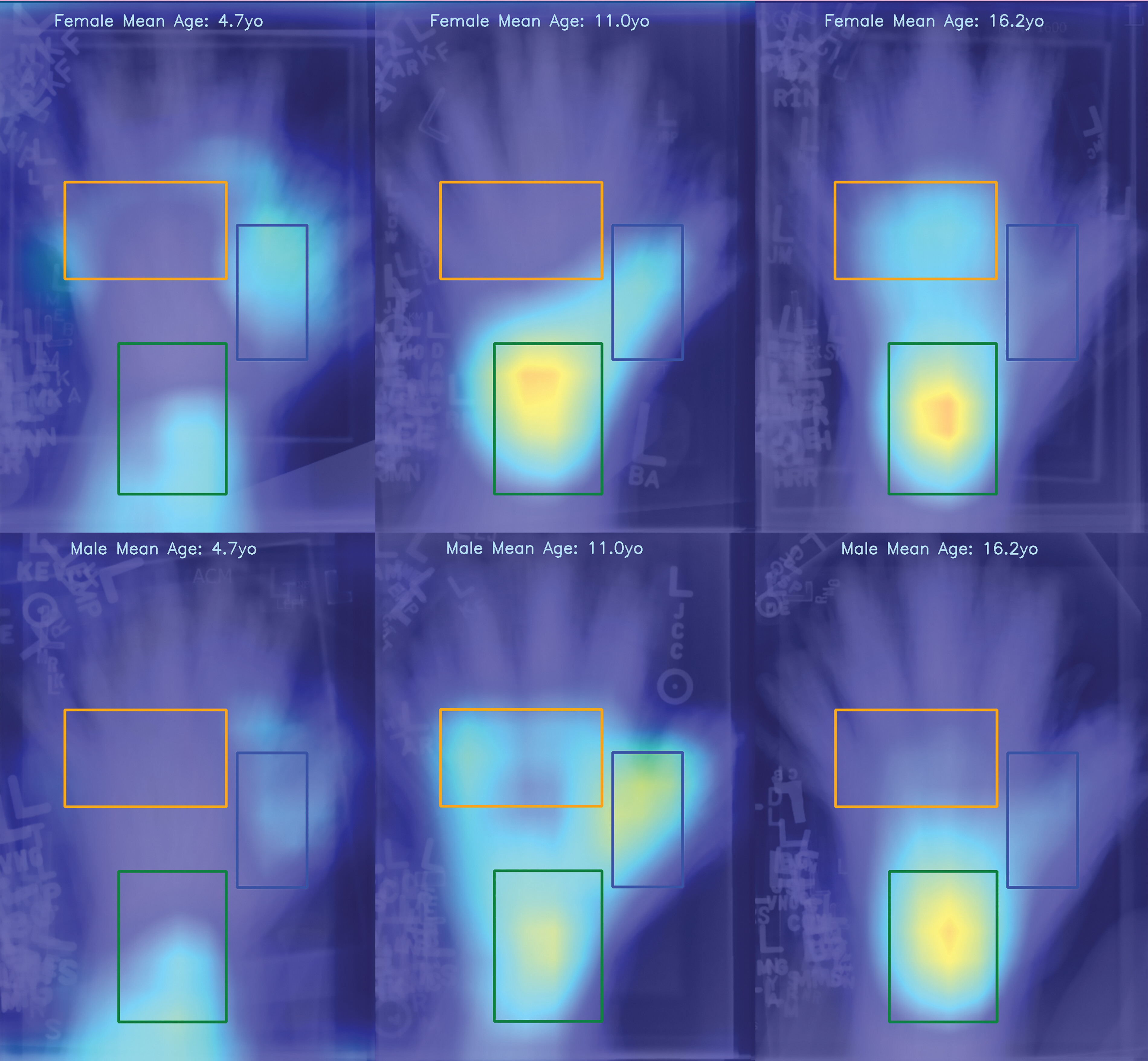 Each modified gradient-weighted class activation map is mean of 30 pediatric hand radiographs performed for bone age est