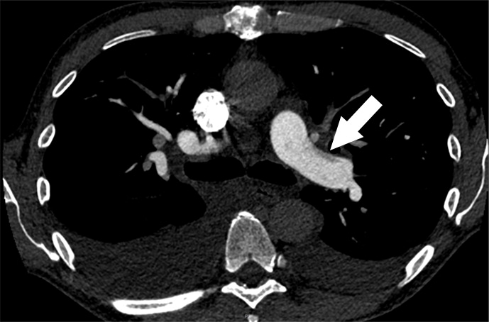 e : Examples of study- and image-level labels. (a) Central Pulmonary Embolism (PE): saddle embolus within the main, righ