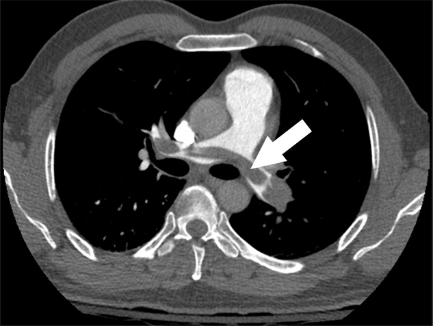 a : Examples of study- and image-level labels. (a) Central Pulmonary Embolism (PE): saddle embolus within the main, righ